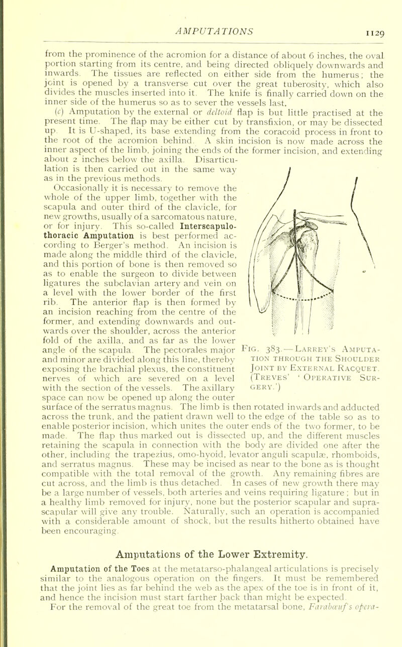 from the prominence of the acromion for a distance of about 6 inches, the oval portion starting from its centre, and being directed obliquely downwards and inwards. The tissues are reflected on either side from the humerus; the joint is opened by a transverse cut over the great tuberosity, which also divides the muscles inserted into it. The knife is finally carried down on the inner side of the humerus so as to sever the vessels last. (c) Amputation by the external or deltoid flap is but little practised at the present time. The flap may be either cut by transfixion, or may be dissected up It is U-shaped, its base extending from the coracoid process in front to the root of the acromion behind. A skin incision is now made across the inner aspect of the limb, joining the ends of the former incision, and extending about 2 inches below the axilla. Disarticu- lation is then carried out in the same way as in the previous methods. Occasionally it is necessary to remove the whole of the upper limb, together with the scapula and outer third of the clavicle, for new growths, usually of a sarcomatous nature, or for injury. This so-called Interscapulo- thoracic Amputation is best performed ac- cording to Berger's method. An incision is made along the middle third of the clavicle, and this portion of bone is then removed so as to enable the surgeon to divide between ligatures the subclavian artery and vein on a level with the lower border of the first rib The anterior flap is then formed by an incision reaching from the centre of the former, and extending downwards and out- wards over the shoulder, across the anterior fold of the axilla, and as far as the lower angle of the scapula The pectorales major Fig. 383. — Larrey's Amputa- and minor are divided along this line, thereby tion through the Shoulder exposing the brachial plexus, the constituent nerves of which are severed on a level with the section of the vessels. The axillary- space can now be opened up along the outer surface of the serratus magnus. The limb is then rotated inwards and adducted across the trunk, and the patient drawn well to the edge of the table so as to enable posterior incision, which unites the outer ends of the two former, to be made. The flap thus marked out is dissected up, and the different muscles retaining the scapula in connection with the body are divided one after the other, including the trapezius, omo-hyoid, levator anguli scapulae, rhomboids, and serratus magnus. These may be incised as near to the bone as is thought compatible with the total removal of the growth. Any remaining fibres are cut across, and the limb is thus detached. In cases of new growth there may be a large number of vessels, both arteries and veins requiring ligature ; but in a healthy limb removed for injury, none but the posterior scapular and supra- scapular will give any trouble. Naturally, such an operation is accompanied with a considerable amount of shock, but the results hitherto obtained have been encouraging. Joint by External Racquet. (Treves' 1 Operative Sur- gery.') Amputations of the Lower Extremity. Amputation of the Toes at the metatarso-phalangeal articulations is precisely similar to the analogous operation on the fingers. It must be remembered that the joint lies as far behind the web as the apex of the toe is in front of it, and hence the incision must start farther back than might be expected. For the removal of the great toe from the metatarsal bone, Farabaufs opera-