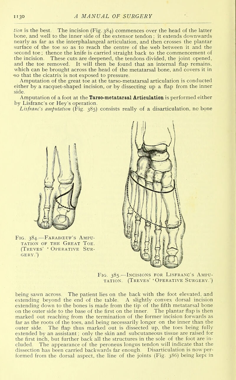 tion is the best. The incision (Fig. 384) commences over the head of the latter bone, and well to the inner side of the extensor tendon; it extends downwards nearly as far as the interphalangeal articulation, and then crosses the plantar surface of the toe so as to reach the centre of the web between it and the second toe ; thence the knife is carried straight back to the commencement of the incision. These cuts are deepened, the tendons divided, the joint opened, and the toe removed. It will then be found that an internal flap remains, which can be brought across the head of the metatarsal bone, and covers it in •so that the cicatrix is not exposed to pressure. Amputation of the great toe at the tarso-metatarsal articulation is conducted either by a racquet-shaped incision, or by dissecting up a flap from the inner side. Amputation of a foot at the Tarso-metatarsal Articulation is performed either by Lisfranc's or Hey's operation. Lisfranc's amputation (Fig. 385) consists really of a disarticulation, no bone Fig. 385.—Incisions for Lisfranc's Ampu- tation. (Treves' 'Operative Surgery.') being sawn across. The patient lies on the back with the foot elevated, and extending beyond the end of the table. A slightly convex dorsal incision extending down to the bones is made from the tip of the fifth metatarsal bone on the outer side to the base of the first on the inner. The plantar flap is then marked out reaching from the termination of the former incision forwards as far as the roots of the toes, and being necessarily longer on the inner than the outer side. The flap thus marked out is dissected up, the toes being fully extended by an assistant; only the skin and subcutaneous tissue are raised for the first inch, but further back all the structures in the sole of the foot are in- cluded. The appearance of the peroneus longus tendon will indicate that the dissection has been carried backwards far enough. Disarticulation is now per- formed from the dorsal aspect, the line of the joints (Fig. 386) being kept in