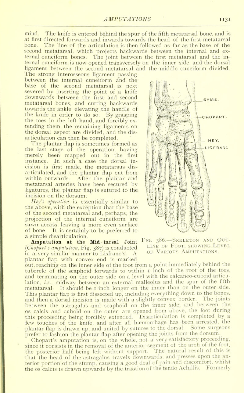 C H 0 PART. US F RANC mind. The knife is entered behind the spur of the fifth metatarsal bone, and is at first directed forwards and inwards towards the head of the first metatarsal bone. The line of the articulation is then followed as far as the base of the second metatarsal, which projects backwards between the internal and ex- ternal cuneiform bones. The joint between the first metatarsal, and the in- ternal cuneiform is now opened transversely on the inner side, and the dorsal ligament between the second metatarsal and the middle cuneiform divided. The strong interosseous ligament passing between the internal cuneiform and the base of the second metatarsal is next severed by inserting the point of a knife downwards between the first and second metatarsal bones, and cutting backwards towards the ankle, elevating the handle of the knife in order to do so. By grasping the toes in the left hand, and forcibly ex- tending them, the remaining ligaments on the dorsal aspect are divided, and the dis- articulation can then be completed. The plantar flap is sometimes formed as the last stage of the operation, having merely been mapped out in the first instance. In such a case the dorsal in- cision is first made, the metatarsus dis- articulated, and the plantar flap cut from within outwards. After the plantar and metatarsal arteries have been secured by ligatures, the plantar flap is sutured to the incision on the dorsum. Hey's operation is essentially similar to the above, with the exception that the base of the second metatarsal and, perhaps, the projection of the internal cuneiform are sawn across, leaving a more even surface of bone. It is certainly to be preferred to a simple disarticulation. Amputation at the Mid-tarsal Joint (Chopart's amputation, Fig. 387) is conducted in a very similar manner to Lisfranc's. A plantar flap with convex end is marked out, reaching on the inner side of the foot from a point immediately behind the tubercle of the scaphoid forwards to within 1 inch of the root of the toes, and terminating on the outer side on a level with the calcaneo-cuboid articu- lation, i.e., midway between an external malleolus and the spur of the fifth metatarsal. It should be 1 inch longer on the inner than on the outer side. This plantar flap is first dissected up, including everything down to the bones, and then a dorsal incision is made with a slightly convex border. The joints between the astragalus and scaphoid on the inner side, and between the os calcis and cuboid on the outer, are opened from above, the foot during this proceeding being forcibly extended. Disarticulation is completed by a few touches of the knife, and after all haemorrhage has been arrested, the plantar flap is drawn up, and united by sutures to the dorsal. Some surgeons prefer to fashion the plantar flap after opening the joints from the dorsum. Chopart's amputation is, on the whole, not a very satisfactory proceeding, since it consists in the removal of the anterior segment of the arch of the foot, the posterior half being left without support. The natural result of this is that the head of the astragalus travels downwards, and presses upon the an- terior portion of the stump, causing a good deal of pain and discomfort, whilst the os calcis is drawn upwards by the traction of the tendo Achillis. Formerly Fig. 3S6—Skeleton and Out- line of Foot, showing Level of Various Amputations.
