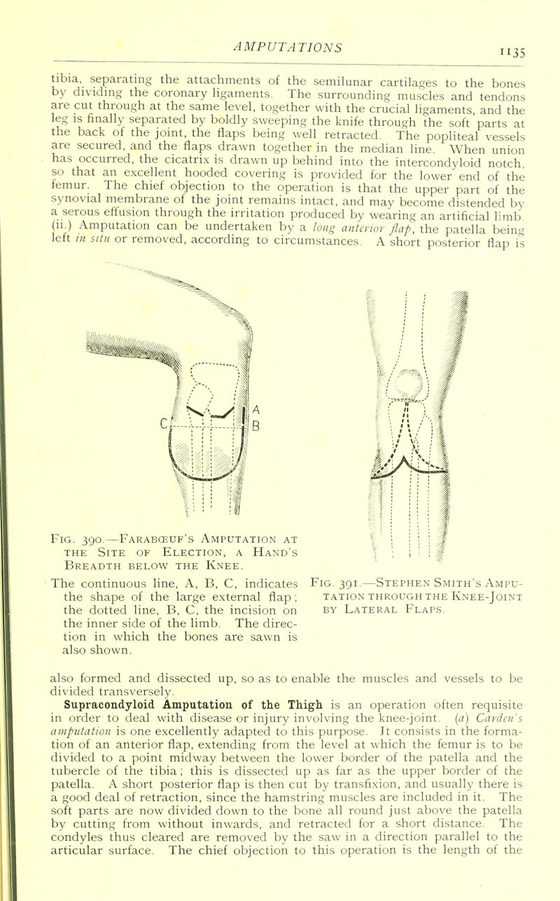 tibia, separating the attachments of the semilunar cartilages to the bones by dividing the coronary ligaments. The surrounding muscles and tendons are cut through at the same level, together with the crucial ligaments, and the leg is finally separated by boldly sweeping the knife through the soft parts at the back of the joint, the flaps being well retracted. The popliteal vessels are secured, and the flaps drawn together in the median line. When union has occurred, the cicatrix is drawn up behind into the intercondyloid notch, so that an excellent hooded covering is provided for the lower end of the femur. The chief objection to the operation is that the upper part of the synovial membrane of the joint remains intact, and may become distended by a serous effusion through the irritation produced by wearing an artificial limb (ii.) Amputation can be undertaken by a long anterior flap, the patella being left in situ or removed, according to circumstances. A short posterior flap is The continuous line, A, B, C, indicates Fig. 391.—Stephen Smith's Ampc- the shape of the large external flap; tation through the Knee-Joint the dotted line, B, C, the incision on by Lateral Flaps. the inner side of the limb. The direc- tion in which the bones are sawn is also shown. also formed and dissected up, so as to enable the muscles and vessels to be divided transversely. Supracondyloid Amputation of the Thigh is an operation often requisite in order to deal with disease or injury involving the knee-joint, (a) Garden'% amputation is one excellently adapted to this purpose. Jt consists in the forma- tion of an anterior flap, extending from the level at which the femur is to be divided to a point midway between the lower border of the patella and the tubercle of the tibia; this is dissected up as far as the upper border of the patella. A short posterior flap is then cut by transfixion, and usually there is a good deal of retraction, since the hamstring muscles are included in it. The soft parts are now divided down to the bone all round just above the patella by cutting from without inwards, and retracted for a short distance. The condyles thus cleared are removed by the saw in a direction parallel to the articular surface. The chief objection to this operation is the length of the