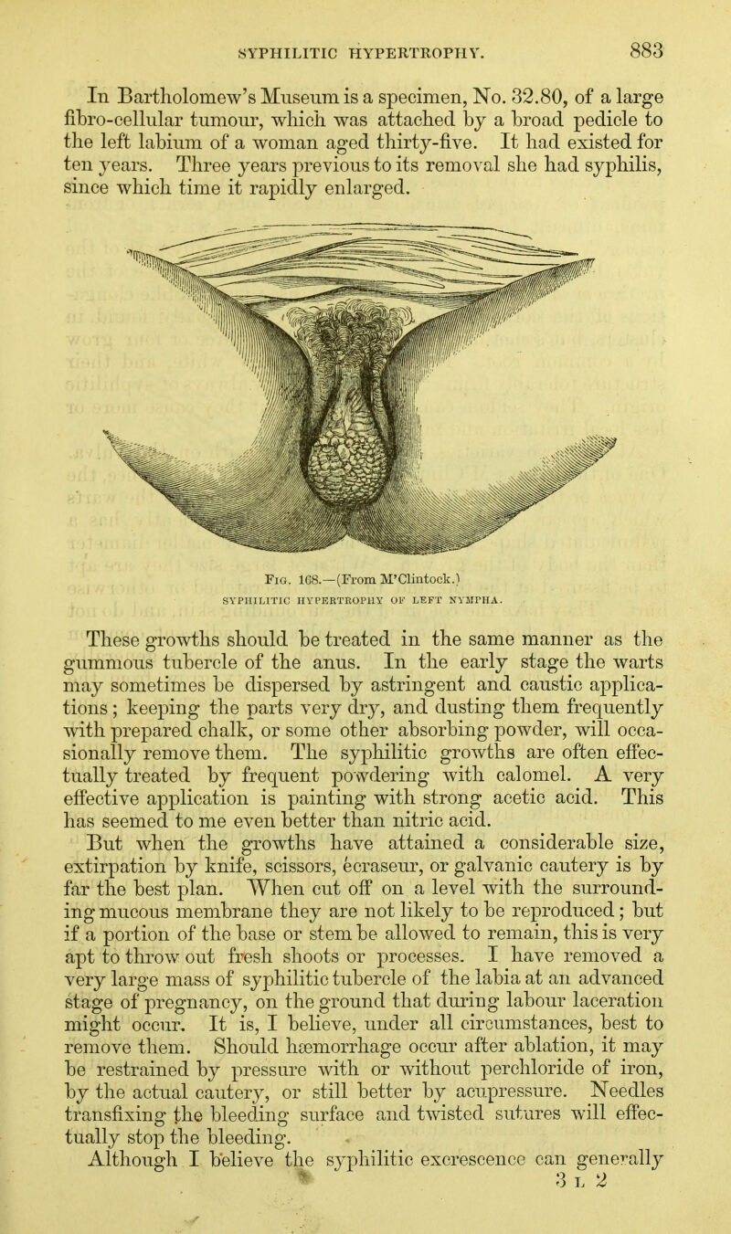 In Bartholomew's Museum is a specimen, No. 32.80, of a large fibro-cellular tumour, which was attached bj a broad pedicle to the left labium of a woman aged thirty-five. It had existed for ten years. Three years previous to its removal she had syphilis, since which time it rapidly enlarged. Fig. 108.—(From M'Clintock.) SYPHILITIC HYPERTROPHY OF LEFT NYMTHA. These growths should be treated in the same manner as the gummous tubercle of the anus. In the early stage the warts may sometimes be dispersed by astringent and caustic applica- tions ; keeping the parts very dry, and dusting them frequently with prepared chalk, or some other absorbing powder, will occa- sionally remove them. The syphilitic growths are often effec- tually treated by frequent powdering with calomel. A very effective application is painting with strong acetic acid. This has seemed to me even better than nitric acid. But when the growths have attained a considerable size, extirpation by knife, scissors, ecraseur, or galvanic cautery is by far the best plan. When cut off on a level with the surround- ing mucous membrane they are not likely to be reproduced; but if a portion of the base or stem be allowed to remain, this is very apt to throw out fresh shoots or processes. I have removed a very large mass of syphilitic tubercle of the labia at an advanced stage of pregnancy, on the ground that during labour laceration might occur. It is, I believe, under all circumstances, best to remove them. Should haemorrhage occur after ablation, it may be restrained by pressure with or without perchloride of iron, by the actual cautery, or still better by acupressure. Needles transfixing the bleeding surface and twisted sutures will effec- tually stop the bleeding. Although I believe the syphilitic excrescence can generally 3 l 2