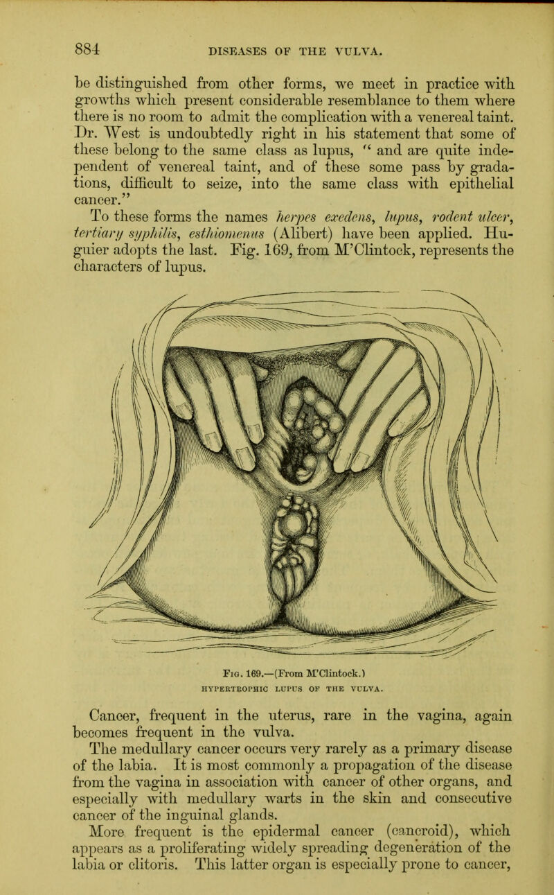 be distinguished from other forms, we meet in practice with growths which present considerable resemblance to them where there is no room to admit the complication with a venereal taint. Dr. West is undoubtedly right in his statement that some of these belong to the same class as lupus,  and are quite inde- pendent of venereal taint, and of these some pass by grada- tions, difficult to seize, into the same class with epithelial cancer. To these forms the names herpes exedens, lupus, rodent ulcer, tertiary syphilis, esthiomenus (Alibert) have been applied. Hu- guier adopts the last. Fig. 169, from M'Clintock, represents the characters of lupus. Fig. 169.—(From M'Clintock.) HYPERTROPHIC LUPUS OF THE VULVA. Cancer, frequent in the uterus, rare in the vagina, again becomes frequent in the vulva. The medullary cancer occurs very rarely as a primary disease of the labia. It is most commonly a propagation of the disease from the vagina in association with cancer of other organs, and especially with medullary warts in the skin and consecutive cancer of the inguinal glands. More frequent is the epidermal cancer (cancroid), which appears as a proliferating widely spreading degeneration of the labia or clitoris. This latter organ is especially prone to cancer,