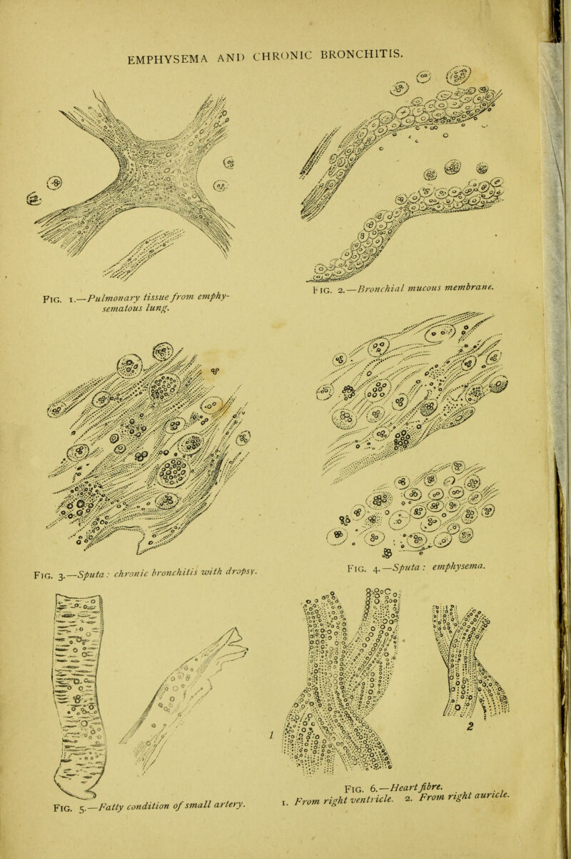 EMPHYSEMA AND CHRONIC BRONCHITIS. X.—Pulmonary tissue from emphy- sematous lung. y—Sputa: chronic bronchitis with dropsy. Y\Q, t,.—Fatty condition of small artery. /oo\ ' #® ® /pJFW • .Ufff^ ]h 2,,—Bronchial mucous membrane.. , ••... .• „ ^y.M^ M-i^ .-' • . ; oP-; f ,.oV -cS^ p-iQ_ sputa: emphysema. 1 ^mofmm^ ■mm it Fig. b.—Heart pre. .