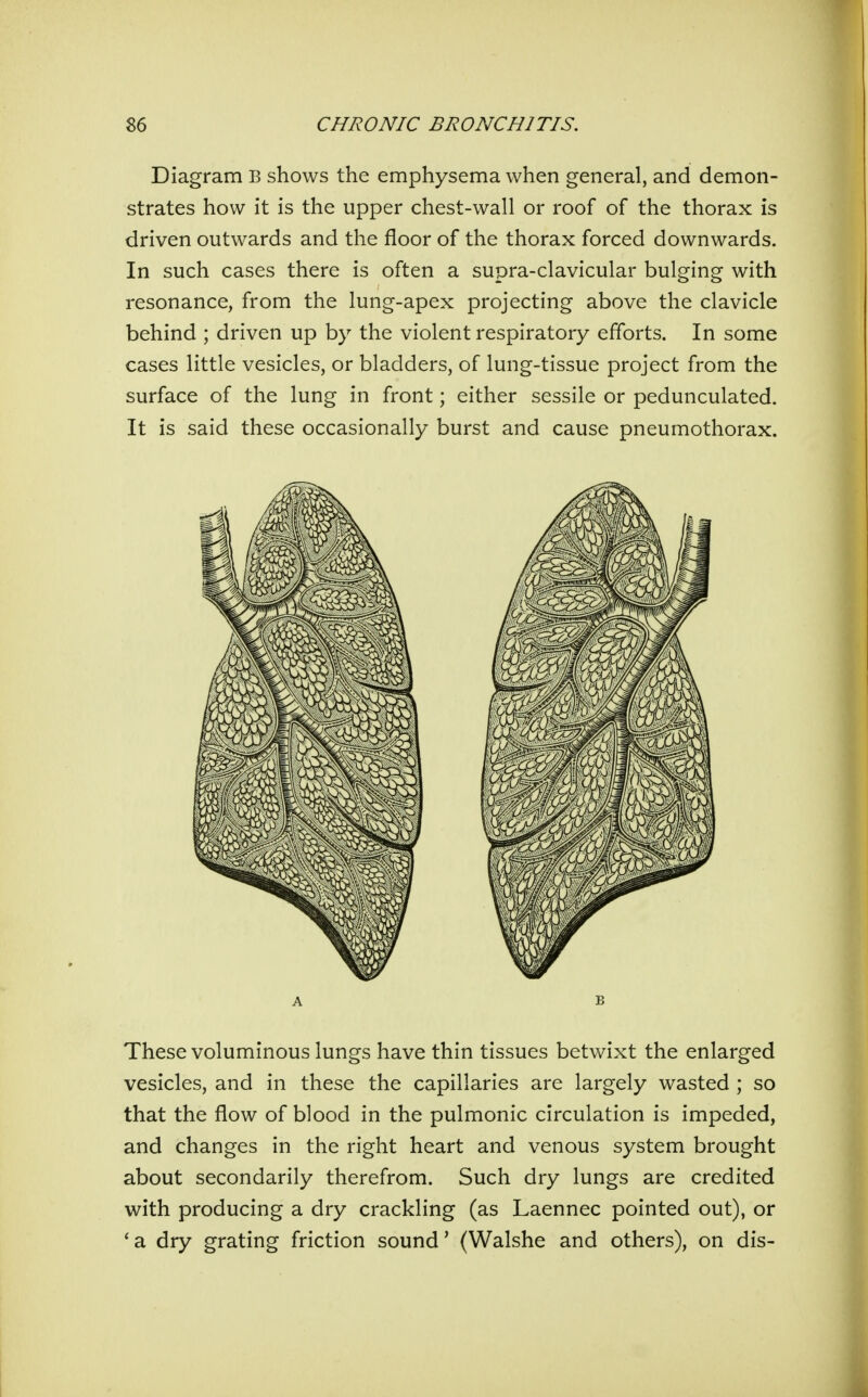 Diagram B shows the emphysema when general, and demon- strates how it is the upper chest-wall or roof of the thorax is driven outwards and the floor of the thorax forced downwards. In such cases there is often a supra-clavicular bulging with resonance, from the lung-apex projecting above the clavicle behind ; driven up by the violent respiratory efforts. In some cases little vesicles, or bladders, of lung-tissue project from the surface of the lung in front; either sessile or pedunculated. It is said these occasionally burst and cause pneumothorax. A B These voluminous lungs have thin tissues betwixt the enlarged vesicles, and in these the capillaries are largely wasted ; so that the flow of blood in the pulmonic circulation is impeded, and changes in the right heart and venous system brought about secondarily therefrom. Such dry lungs are credited with producing a dry crackling (as Laennec pointed out), or 'a dry grating friction sound' (Walshe and others), on dis-