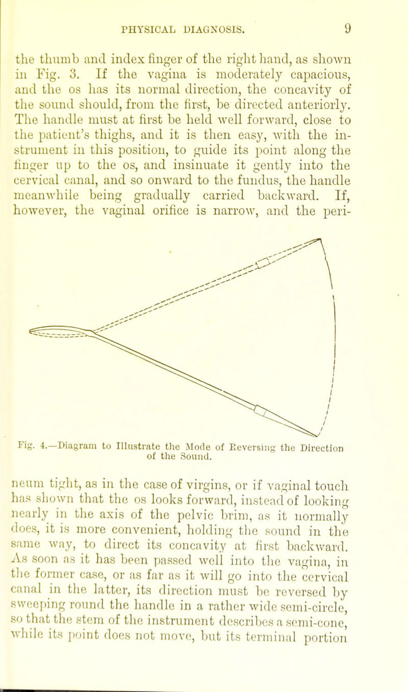 the thumb and index finger of the right hand, as shown in Fig. 3. If the vagina is moderately capacious, and the os has its normal direction, the concavity of the sound should, from the first, be directed anteriorly. The handle must at first be held well forward, close to the patient's thighs, and it is then easy, with the in- strument in this position, to guide its point along the finger up to the os, and insinuate it gently into the cervical canal, and so onward to the fundus, the handle meanwhile being gradually carried backward. If, however, the vaginal orifice is narrow, and the peri- Fig, i.—Diagram to Illustrate the Mode of Reversing the Direction of the .Sound. neum tight, as in the case of virgins, or if vaginal touch has shown that the os looks forward, instead of looking nearly in the axis of the pelvic brim, as it normally does, it is more convenient, holding the sound in the same way, to direct its concavity at first backward. Aa soon as it has been passed well into the vagina, in the former case, or as far as it will go into the cervical canal in the latter, its direction must be reversed by sweeping round the handle in a rather wide semi-circle, so that the stem of the instrument describes a semi-cone, while its point does not move, but its terminal portion