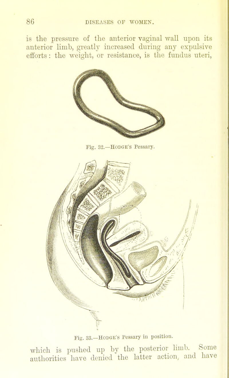 is the pressure of the anterior vaginal Avail upon its anterior limb, greatly increased during any expulsive efforts : the weight, or resistance, is the fundus uteri, Fig. 32.—Hodge's Pessary- Fig. 33.—Hodge's Pessary in position. which is pushed up by the posterior limb. Some authorities have denied the latter action, and have