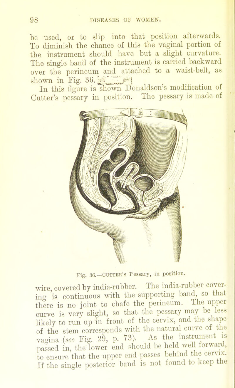 be used, or to slip into that position afterwards. To diminish the chance of this the vaginal portion of the instrument should have but a slight curvature. The single band of the instrument is carried backward over the perineum and attached to a waist-belt, as shown in Fig. 36. ^J^j^j In this figure is shown Donaldson's modification of Cutter's pessary in position. The pessary is made of Fig. 36.—Gutter's Pessary, in position. wire, covered by india-rubber. The india-rubber cover- ing is continuous with the supporting band, so that there is no joint to chafe the perineum. The upper curve is very slight, so that the pessary may be less likely to run up in front of the cervix, and the shape of the stem corresponds with the natural curve of the vagina (see Tig. 29, p. 73). As the instrument is passed in, the lower end should be held well forward, to ensure that the upper end passes behind the cervix. If the single posterior band is not found to keep tJie