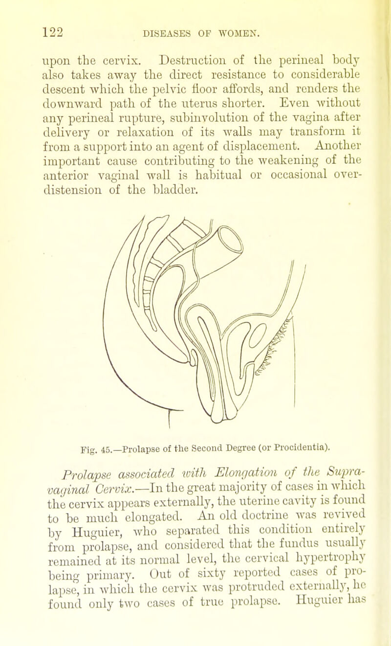 upon the cervix. Destruction of the perineal body also takes away the direct resistance to considerable descent which the pelvic floor affords, and renders the downward path of the uterus shorter. Even without any perineal rupture, subinvolution of the vagina after delivery or relaxation of its walls may transform it from a support into an agent of displacement. Another important cause contributing to the weakening of the anterior vaginal wall is habitual or occasional over- distension of the bladder. Fig. 45.—Prolapse of the Second Degree (or Procidentia). Prolapse associated with Elongation of the Supra- vaginal Cervix.—In the great majority of cases in which the cervix appears externally, the uterine cavity is found to be much elongated. An old doctrine was revived by Huguier, who separated this condition entirely from prolapse, and considered that the fundus usually remained at its normal level, the cervical hypertrophy being primary. Out of sixty reported cases of pro- lapse, in which the cervix was protruded externally, he found only two cases of true prolapse. Huguier has