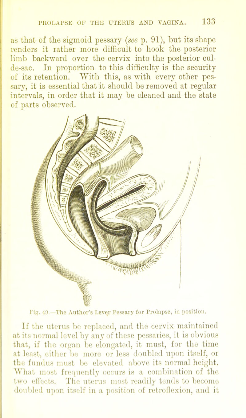 as that of the sigmoid pessary (see p. 91), but its shape renders it rather more difficult to hook the posterior limb backward over the cervix into the posterior cul- de-sac. In proportion to this difficulty is the security of its retention. With this, as with every other pes- sary, it is essential that it should be removed at regular intervals, in order that it may be cleaned and the state of parts observed. I 1(5. : l The Author's Lever Pessary tor Prolapse, in position. If the uterus be replaced, and the cervix maintained at its normal level by any of these pessaries, it is obvious that, if the organ be elongated, it must,, for the time at least, either be more or Less doubled upon itself, or the fundus must, be elevated above its normal height. Whal most frequently occurs is a combination of the two effects. The uterus most readily tends to become doubled upon itself in a position of retroflexion, and it,