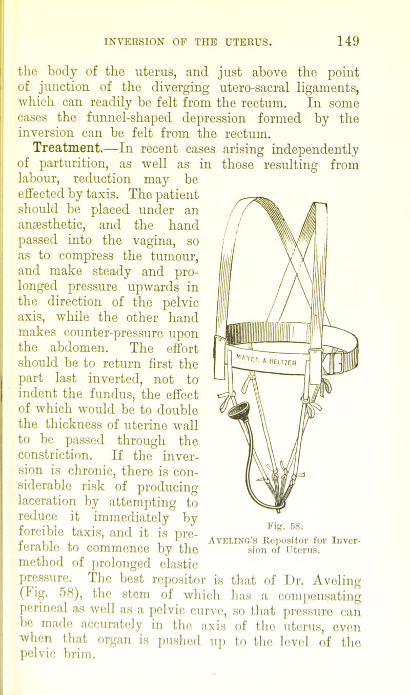 the body of the uterus, and just above the point of junction of the diverging utero-sacral ligaments, which can readily be felt from the rectum. In some cases the funnel-shaped depression formed by the inversion can be felt from the rectum. Treatment.—In recent cases arising independently of parturition, as well as in those resulting from labour, reduction may be effected by taxis. The patient should be placed under an anesthetic, and the hand passed into the vagina, so as to compress the tumour, and make steady and pro- longed pressure upwards in the direction of the pelvic axis, while the other hand makes counter-pressure upon the abdomen. The effort should be to return first the part last inverted, not to indent the fundus, the effect of which would be to double the thickness of uterine wall to be passed through the constriction. If the inver- sion is chronic, there is con- siderable risk of producing laceration by attempting to reduce it immediately by forcible taxis, and it is pre- ferable to commence by the method of prolonged clastic pressure. The best repositor is that of Di (Fig. 58), the stem of which 1 las a compensating perineal as well as a pelvic curve, so that pressure can be made accurately in the axis of the uterus, even when that organ is pushed up to the level of the pelvic brim. Fig. 58. Avkling's Repositor tor Inver- sion of ru-riis. Aveling