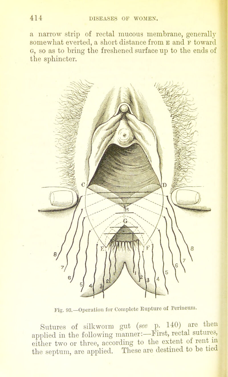 a narrow strip of rectal mucous membrane, generally somewhat everted, a short distance from e and f toward G, so as to bring the freshened surface up to the ends of the sphincter.