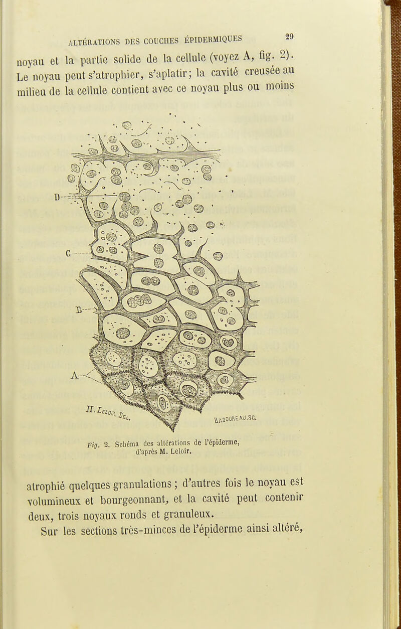 noyau et la partie solide de la cellule (voyez A, fig. 2). Le noyau peut s'atrophier, s'aplatir; la cavité creusée au milieu de la cellule contient avec ce noyau plus ou moins Fig. 2. Schéma des altérations de l'épiderme, d'après M. Lcloir. atrophié quelques granulations ; d'autres fois le noyau est volumineux et bourgeonnant, et la cavité peut contenir deux, trois noyaux ronds et granuleux. Sur les sections très-minces de l'épiderme ainsi altéré,