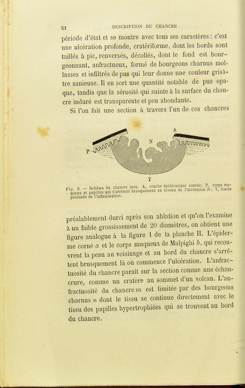 période d'état et se montre avec tous ses caractères : c'est une ulcération profonde, cratériforme, dont les bords sont taillés à pic, renversés, décollés, dont le fond est bour- geonnant, anfractueux, formé de bourgeons charnus mol- lasses et infiltrés de pus qui leur donne une couleur grisâ- tre sanieuse. Il en sort une quantité notable de pus opa- que, tandis que la sérosité qui suinte à la surface du chan- cre induré est transparente et peu abondante. Si l'on fait une section à travers l'un de ces chancres c,,,,,.. j„ Mnncre mou. A, couche épidermique cornée; P, corps mu- F,2ueuiêi l$ml qui st brusquement au niveau de l'ulcération N; T, hm.te profonde de l'inflammation. préalablement durci après son ablation et qu'on l'examine à un faible grossissement de 20 diamètres, on obtient une figure analogue à la figure 1 de la planche II. L'épider- me corné a et le corps muqueux de Malpighi &, qui recou- vrent la peau au voisinage et au bord du chancre s'arrê- tent brusquement là où commence l'ulcération. L'anfrac- tuosité du chancre paraît sur la section comme une échan- crure, comme un cratère au sommet d'un volcan. L'an- fractuosité du chancre m est limitée par des bourgeons charnus n dont le tissu se continue directement avec le tissu des papilles hypertrophiées qui se trouvent au bord du chancre.