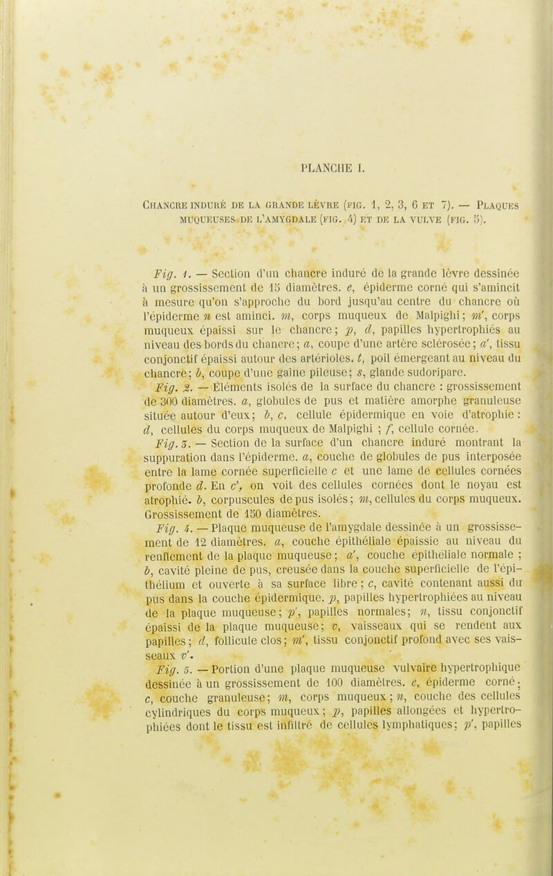 PLANCIIIi [. Chancre induré de la grande lèvre (fig. 1, 2, 3, 6 et 7). — Plaques muqueuses de l'amygdale (fig. 4) et de la vulve (fig. 5). Fig. t. — Section d'un chancre induré de la grande lèvre dessinée à un grossissement de 15 diamètres, e, épidémie corné gui s'amincit à mesure qu'on s'approche du bord jusqu'au centre du chancre où l'épiderme n est aminci, m, corps muqueux de Malpighi ; m', corps muqueux épaissi sur le chancre; p, d, papilles hypertrophiés au niveau des bords du chancre; a, coupe d'une artère sclérosée; a', tissu conjonctif épaissi autour des arlérioles. t, poil émergeant au niveau du chancre; b, coupe d'une gaine pileuse; s, glande sudoripare. Fig. %. — Éléments isolés de la surface du chancre : grossissement de 300 diamètres, a, globules de pus et matière amorphe granuleuse située autour d'eux; b, c, cellule épidermique en voie d'atrophie: d, cellules du corps muqueux de Malpighi ; f, cellule cornée, Fig. 5. — Section de la surface d'un chancre induré montrant la suppuration dans l'épiderme. a, couche de globules de pus interposée entre la lame cornée superficielle c et une lame de cellules cornées profonde d. En c', on voit des cellules cornées dont le noyau est atrophié, b, corpuscules de pus isolés; m, cellules du corps muqueux. Grossissement de 150 diamètres. Fig, 4. _ plaque muqueuse de l'amygdale dessinée à un grossisse- ment de 12 diamètres, a, couche épithéliale épaissie au niveau du renflement de la plaque muqueuse ; a', couche épithéliale normale ; b, cavité pleine de pus, creusée dans la couche superficielle de l'épi- thélium et ouverte à sa surface libre ; c, cavité contenant aussi du pus dans la couche épidermique. p, papilles hypertrophiées au niveau de la plaque muqueuse; p', papilles normales; n, tissu conjonctif épaissi de la plaque muqueuse; v, vaisseaux qui se rendent aux papilles; d, follicule clos ; m', tissu conjonctif profond avec ses vais- seaux v'. Fig. s. — Portion d'une plaque muqueuse vulvaire hypertrophique dessinée à un grossissement de 100 diamètres, e, épidémie corné ; c, couche granuleuse ; m, corps muqueux ; n, couche des cellules cylindriques du corps muqueux ; p, papilles allongées et hypertro- phiées dont le tissu est iÉiltrë de cellules lymphatiques; p', papilles