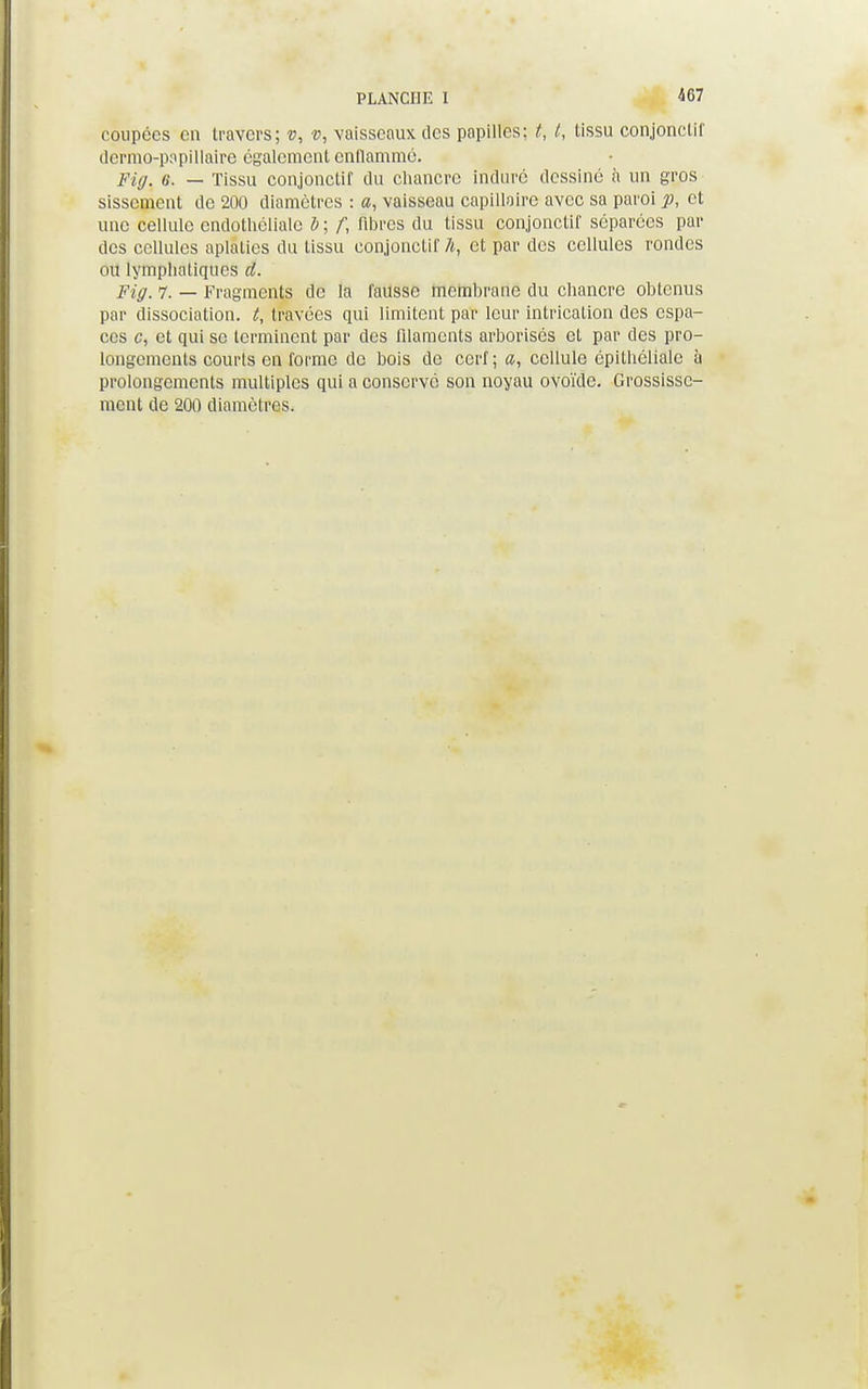467 coupées en travers; v, v, vaisseaux des papilles; t, t, tissu conjonctif dermo-pspillaire également entlammé. Fiff. 6. — Tissu conjonctif du chancre induré dessiné à un gros sissement de 200 diamètres : a, vaisseau capillaire avec sa paroi p, et une cellule endothéliale b ; f, fibres du tissu conjonctif séparées par des cellules aplaties du tissu conjonctif A, et par des cellules rondes ou lymphatiques d. Fig. 7. _ Fragments de la fausse membrane du chancre obtenus par dissociation, t, travées qui limitent par leur intricalion des espa- ces c, et qui se terminent par des filaments arborisés et par des pro- longements courts en forme de bois de cerf; cellule épithélialc à prolongements multiples qui a conservé son noyau ovoïde. Grossisse- ment de 200 diamètres.