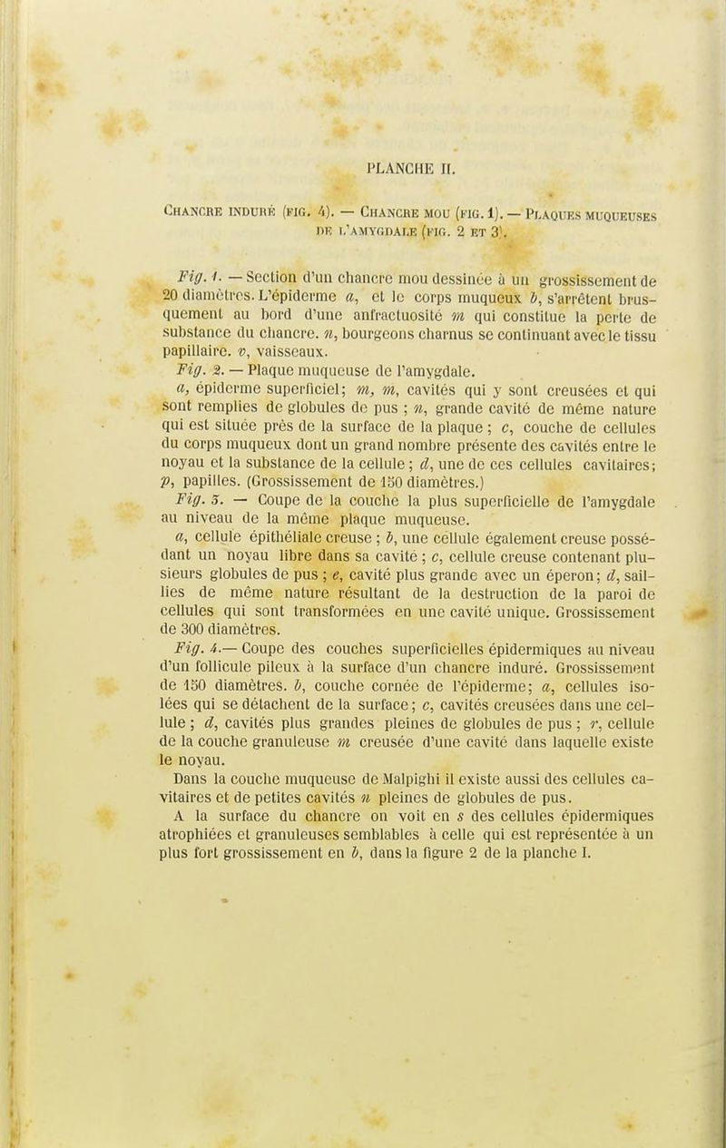 FLANCHE H. Chancre induré (fig. 4). — Chancre mou (fig. 1). — Plaques muqueuses m l'amygdale (fig. 2 et 31. Fig. i. — Seclion d'un chancre mou dessinée à un grossissement de 20 diamètres. L'épidcrme a, et le corps muqueux b, s'arrêtent brus- quement au bord d'une anfractuosité m qui constitue la perte de substance du chancre, n, bourgeons charnus se continuant avec le tissu papillaire. v, vaisseaux. Fig. 2. — Plaque muqueuse de l'amygdale. a, épidcrme superficiel; m, m, cavités qui y sont creusées et qui sont remplies de globules de pus ; n, grande cavité de même nature qui est située près de la surface de la plaque ; c, couche de cellules du corps muqueux dont un grand nombre présente des cavités entre le noyau et la substance de la cellule ; d, une de ces cellules cavitaircs; p, papilles. (Grossissement de 150 diamètres.) Fig. s. — Coupe de la couche la plus superficielle de l'amygdale au niveau de la même plaque muqueuse. a, cellule épithéliale creuse ; b, une cellule également creuse possé- dant un noyau libre dans sa cavité ; c, cellule creuse contenant plu- sieurs globules de pus ; e, cavité plus grande avec un éperon ; d, sail- lies de même nature résultant de la destruction de la paroi de cellules qui sont transformées en une cavité unique. Grossissement de 300 diamètres. Fig. 4.— Coupe des couches superficielles épidermiques au niveau d'un follicule pileux à la surface d'un chancre induré. Grossissement de ISO diamètres, b, couche cornée de l'épidémie; a, cellules iso- lées qui se détachent de la surface ; c, cavités creusées dans une cel- lule ; d, cavités plus grandes pleines de globules de pus ; r, cellule de la couche granuleuse m creusée d'une cavité dans laquelle existe le noyau. Dans la couche muqueuse de Malpighi il existe aussi des cellules ca- vitaires et de petites cavités n pleines de globules de pus. A la surface du chancre on voit en s des cellules épidermiques atrophiées et granuleuses semblables à celle qui est représentée à un