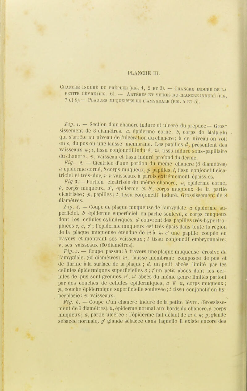 PLANCIIK III. Chancre induré du prépuce (fig. 1, 2 kt 3). - Chancre induré de la petite Lèvre (fig. 6). — Artères et veines du chancre induré (fig. 7 cl 8).— Plaques muqueuses de l'amygdale (fig. 4 et S). Fig. i. — Section d'un chancre induré et ulcéré du prépuce— Gros- sissement de 8 diamètres, a, épiderme corné. !>, corps do Malpighi qui s'arrête au niveau de l'ulcération du chancre; à ce niveau on voit en 6% du pus ou une fausse membrane. Les papilles d, présentent des vaisseaux n; t, tissu conjonctif induré, m, tissu induré sous-papillairc du chancre ; v, vaisseau et tissu induré profond du derme. Fig. 2. — Cicatrice d'une portion du même chancre (8 diamètres) a épiderme corné, I> corps muqueux, p papilles, t, tissu conjonctif cica- triciel el très-dur, v v vaisseaux à parois extrêmement épaissies. Fig S. — Portion cicatrisée du même chancre, «, épiderme corné, i, corps muqueux, a\ épiderme et à\ corps muqueux de la partie cicatrisée ; p, papilles ; t, tissu conjonctif induré. Grossissement de 8 diamètres. Fig. 4. — Coupe de plaque muqueuse de l'amygdale, a épiderme su- perficiel, b épiderme superficiel en partie soulevé, c corps muqueux dont les cellules cylindriques, d couvrent des papilles très-hypertro- phiées e, e, ë ; l'épiderme muqueux est très-épais dans toute la région de la plaque muqueuse étendue de m à n. e' une papille coupée en travers et montrant ses vaisseaux; t tissu conjonctif embryonnaire; v, ses vaisseaux (60 diamètres). Fig. 5.— Coupe passant à travers une plaque muqueuse érosive de l'amygdale. (60 diamètres) m, fausse membrane composée de pus et de fibrine à la surface de la plaque ; d, un petit ahcès limité par les cellules épidermiques superficielles c ; f un petit abcès dont les cel- lules de pus sont grenues, n\ n' abcès du même genre limités partout par des couches de cellules épidermiques. a V corps muqueux ; p, couche épidermique superficielle soulevée; t tissu conjonctif en hy- pcrplasie ; v, vaisseaux. Fig. 6. — Coupe d'un chancre induré de la petite lèvre. (Grossisse- ment de 6 diamètres), n, épiderme normal aux bords du chancre, e, corps muqueux; a, partie ulcérée : l'épiderme fait défaut de m à n; g, glande sébacée normale, #' glande sébacée dans laquelle il existe encore des