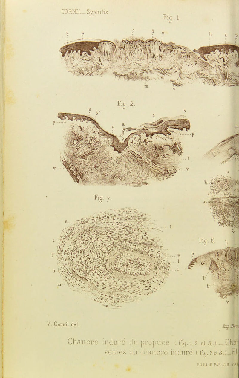 CORNIL-Syphilis, Fig.l. i m Fia. 2. «Il V. Cornil del. Jmp.Btct Chancre inclure du prépuce Uï<;. 1,2 ci 3.) _Ch&fi veines du chancre induré ( Rcj.7et8j_Pl. l'UULIt PAR J.B.BAI