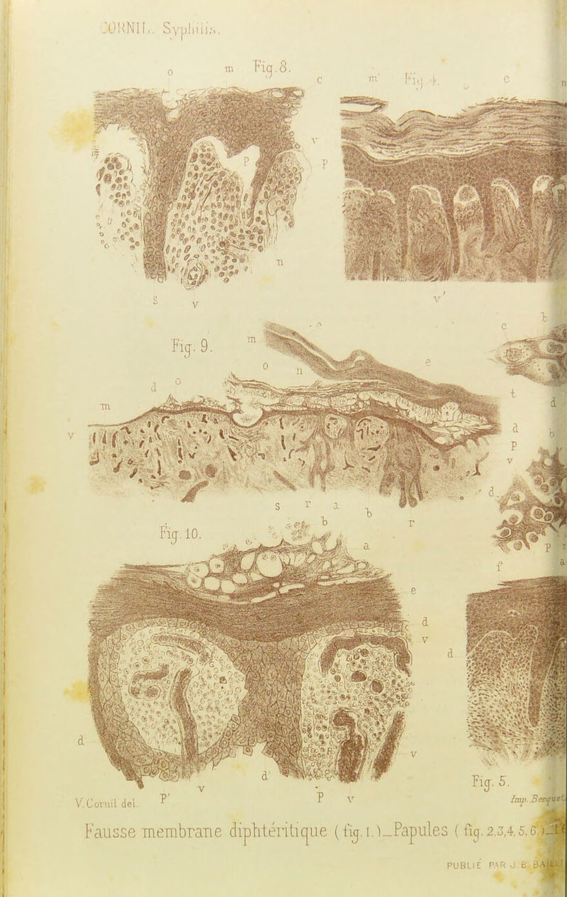 .'OIWIL Syphilis. PUBLIE PAR J.B