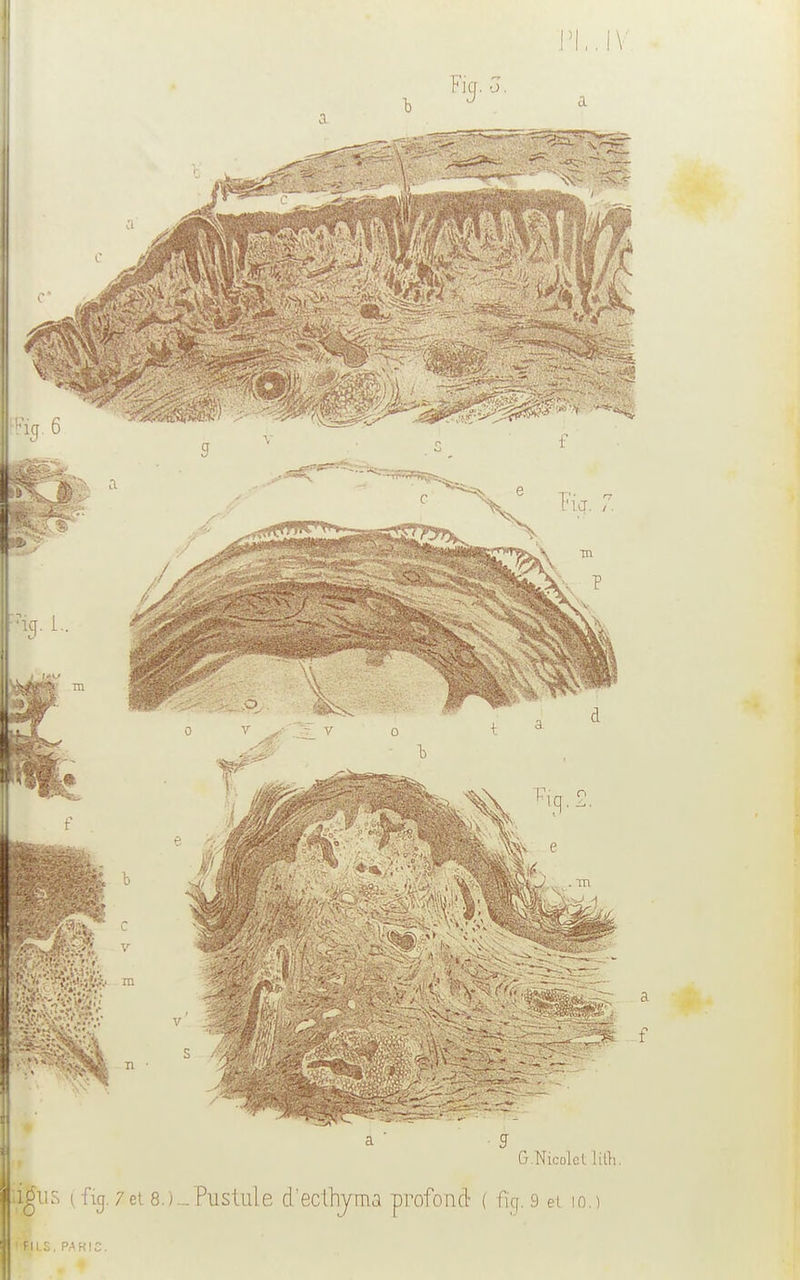 PL. IV a  S G.Nicolcl lift. ■Us ( fig. 7et 8.)-Pustule d'ecfhyma profond ( % 9 et io.) ÉILS, P.AKIC.