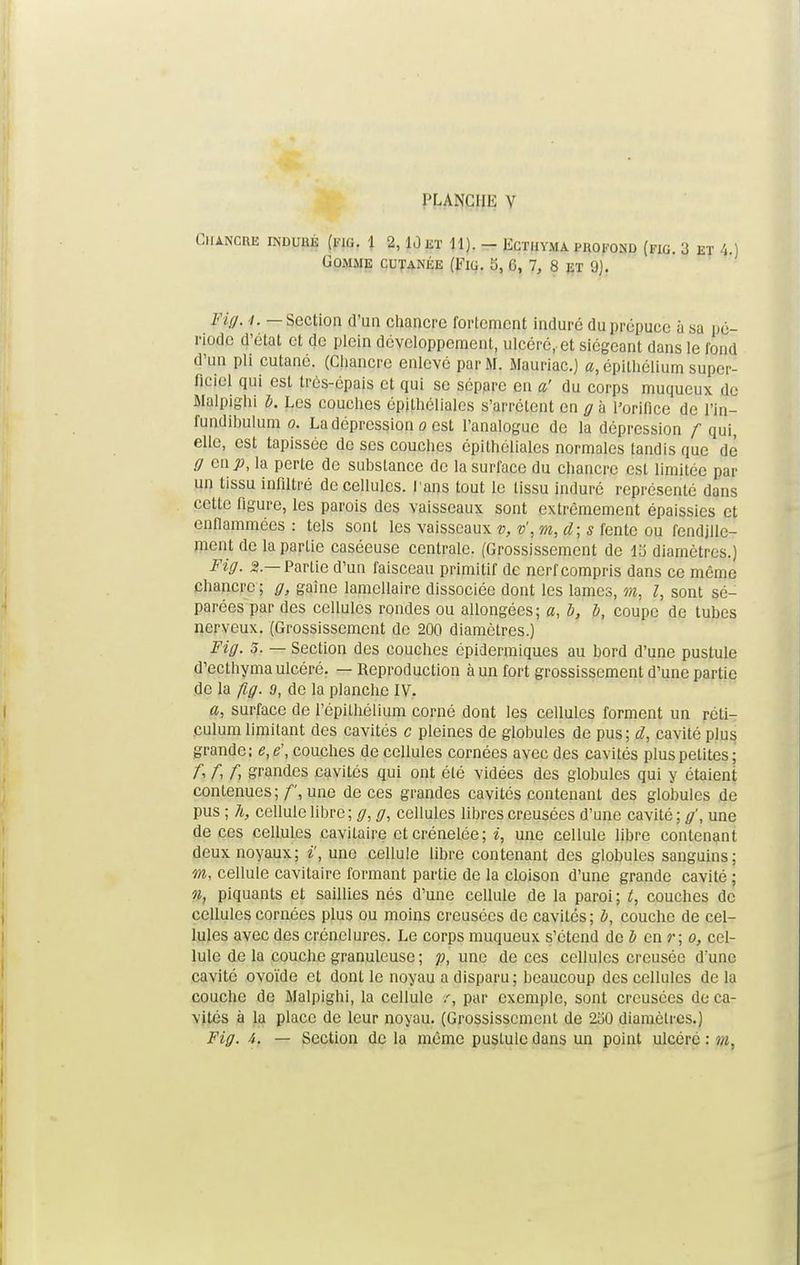 ClUNCBE INDURÉ 1 2, 10 ET 11). - ECTIiYMA PROFOND (FIG. 3 ET 4 ) Gomme cutanée (Eig. S, 6, 7, 8 et 9]. Fh/. t. — Section d'un chancre fortement induré du prépuce à sa pé- riode d'état et de plein développement, ulcéré, et siégeant dans le fond d'un pli cutané. (Chancre enlevé par M. Mauriac.) a, épilhélium super- ficiel qui est trés-épais et qui se sépare eu a' du corps muqueux de Malpighi l. Les couches épithéliales s'arrêtent en g à l'orifice de l'in- fundihulum o. La dépression o est l'analogue de la dépression f qui, elle, est tapissée de ses couches épithéliales normales tandis que dé g en p, la perte de substance de la surface du chancre est limitée par un tissu infiltré de cellules. Pans tout le tissu induré représenté dans cette figure, les parois des vaisseaux sont extrêmement épaissies et enflammées : tels sont les vaisseaux v, v',m, cl; s fente ou fendille- ment de la partie caséeuse centrale. (Grossissement de 13 diamètres.) Fig. 3.—Partie d'un faisceau primitif de nerf compris dans ce même chancre ; g, gaîne lamellaire dissociée dont les lames, m, l, sont sé- parées par des cellules rondes ou allongées; a, b, b, coupe de tubes nerveux. (Grossissement de 200 diamètres.) Fig. 5. — Section des couches épidermiques au bord d'une pustule d'ecthyma ulcéré. — Reproduction à un fort grossissement d'une partie de la fig. 9, de la planche IV. a, surface de l'épithélium corné dont les cellules forment un réli- culum limitant des cavités c pleines de globules de pus; d, cavité plus grande; e,ë, couches de cellules cornées avec des cavités plus petites; A f, f, grandes cavités qui ont été vidées des globules qui y étaient contenues; f, une de ces grandes cavités contenant des globules de pus ; h, cellule libre ; g, g, cellules libres creusées d'une cavité ; g', une de ces cellules cavitaire et crénelée; i, une cellule libre contenant deux noyaux; i', une cellule libre contenant des globules sanguins; m, cellule cavitaire formant partie de la cloison d'une grande cavité ; n, piquants et saillies nés d'une cellule de la paroi ; t, couches de cellules cornées plus ou moins creusées de cavités; b, couche de cel- lules avec des crénelures. Le corps muqueux s'étend de b en r ; o, cel- lule de la couche granuleuse ; p, une de ces cellules creusée d'une cavité ovoïde et dont le noyau a disparu; beaucoup des cellules de la couche de Malpighi, la cellule /, par exemple, sont creusées de ca- vités à la place de leur noyau. (Grossissement de 2o0 diamètres.) Fig. 4. — Section de la même pustule dans un point ulcère: m,