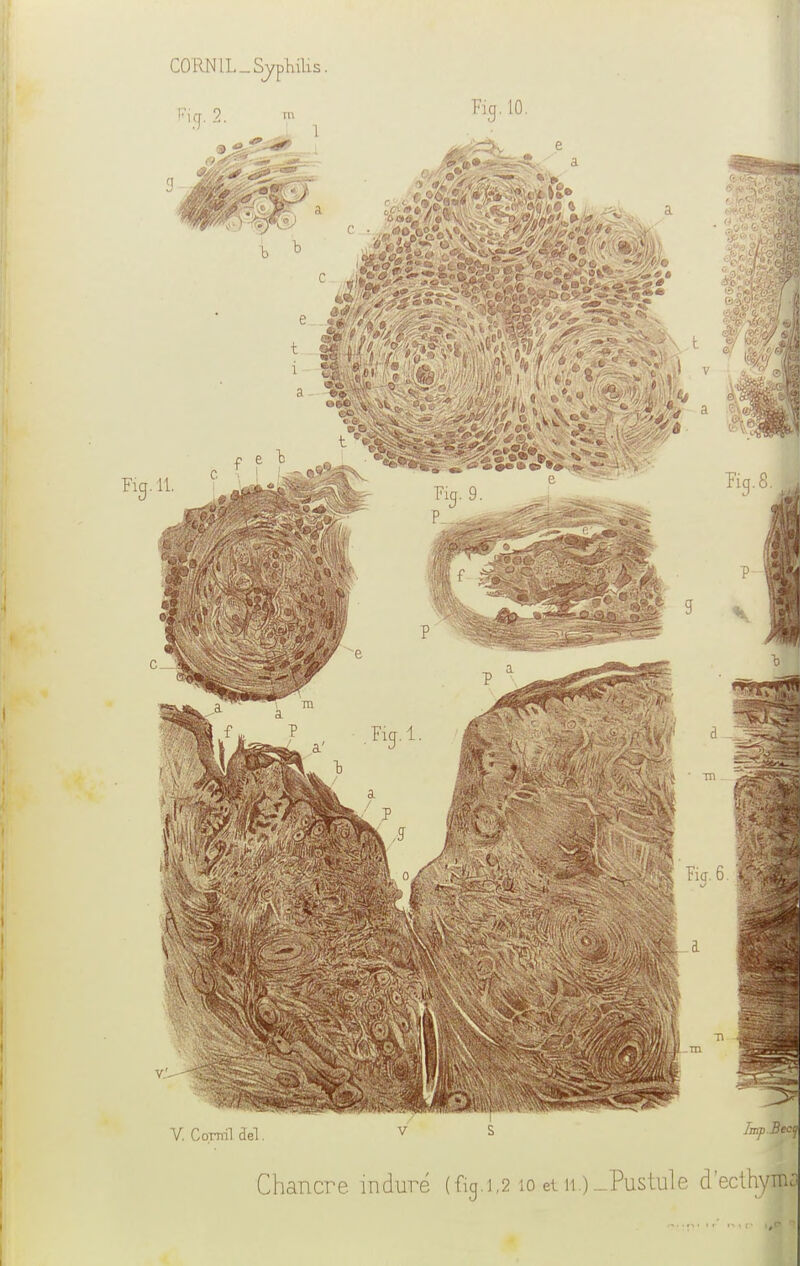Chancre induré (fig.1,2 10 et n.)-Pustule d'ecihyma