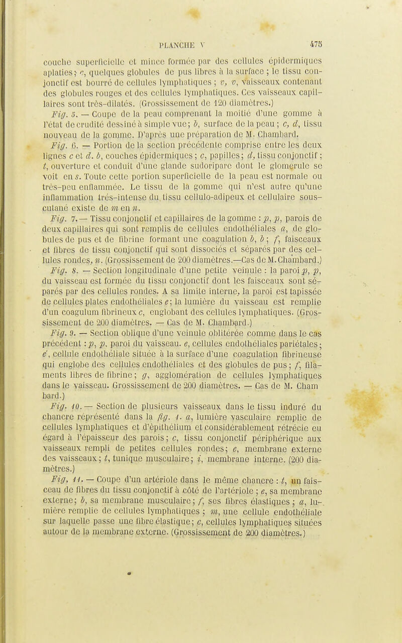 couche superficielle et mince formée par dos cellules épldermiques aplaties? c, quelques globules de pus libres à la surface ; le tissu con- jonctif est bourré de cellules lymphatiques ; v, v, vaisseaux contenant des globules rouges et des cellules lymphatiques. Ces vaisseaux capil- laires sont très-dilatés. (Grossissement de 120 diamètres.) Fty, s, — Coupe de la peau comprenant la moitié d'une gomme à l'état de crudité dessiné à simple vue; h, surface de la peau; c, cl, tissu nouveau de la gomme. D'après une préparation de M. Cbambard. Fiff. 6. — Portion delà section précédente comprise entre les deux lignes cet cl. b, couches épidermiques ; c, papilles; cl, tissu conjonctif ; t, ouverture et conduit d'une glande sudoriparc dont le glomerule se voit en s. Toute cette portion superficielle de la peau est normale ou très-peu enflammée. Le tissu de la gomme qui n'est autre qu'une inflammation Irés-intense du. tissu ccllulo-adipeux et cellulaire sous- culané existe de m en «. Fiff. 7.— Tissu conjonctif et capillaires de la gomme :p, p, parois de deux capillaires qui sont remplis de cellules endothéliales a, de glo- bules de pus et de fibrine formant une coagulation b, b ; f, faisceaux et libres de tissu conjonctif qui sont dissociés et séparés par des cel- lules rondes,, n. (Grossissement de 200diamètres.—Cas deM.Chambard.) Fiff. S. — Section longitudinale d'une petite veinule : la paroi p, p, du vaisseau est formée du tissu conjonctif dont les faisceaux sont sé- parés par des cellules rondes. A sa limite interne, la paroi est tapissée de cellules plates endothéliales e; la lumière du vaisseau est remplie d'un coagulum fibrineuxe, englobant des cellules lymphatiques. (Gros- sissement de 200 diamètres. — Cas de M. Chambard.) Fit/. 9. — Section oblique d'une veinule oblitérée comme dans le cas précédent : p, p. paroi du vaisseau, e, cellules endothéliales pariétales ; ë, cellule endothéliale située à la surface d'une coagulation fibrineuse qui englobe des cellules endothéliales et des globules de pus ; /; fila- ments libres de fibrine ; ff, agglomération de cellules lymphatiques dans le vaisseau. Grossissement de 200 diamètres. — Cas de M. Cham bard.) Fiff. 40.— Section de plusieurs vaisseaux dans le tissu induré du chancre réprésenté dans la fiff. i. a, lumière vasculairc remplie de cellules lymphatiques et d'èpithélium et considérablement rétrécie eu égard à l'épaisseur des parois ; c, tissu conjonctif périphérique aux vaisseaux rempli de petites cellules rondes; e, membrane externe des vaisseaux; t, tunique musculaire; i, membrane interne. (200 dia- mètres.) Fiff, ij, — Coupe d'un artériole dans le même chancre : t, un fais- ceau de fibres du tissu conjonctif à côté de l'artériole ; e, sa membrane externe; i, sa membrane musculaire; f, ses fibres élastiques ; a, lu-, mière remplie de cellules lymphatiques ; m, une cellule endothéliale sur laquelle passe une libre élastique ; c, cellules lymphatiques situées autour de la membrane externe. (Grossissement de 200 diamètres.)