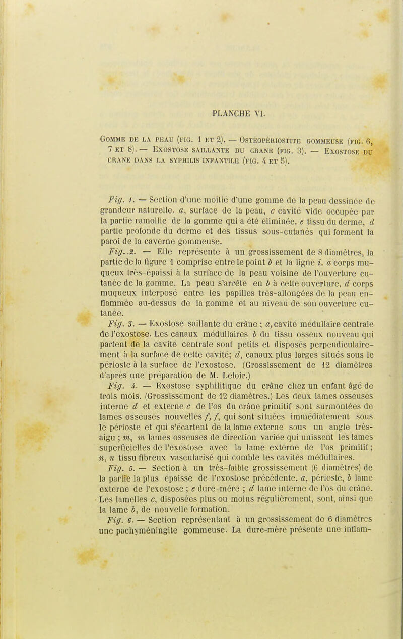 Gomme de la peau (fig. 1 et 2). — Ostéopériostite gommeuse (fig. 6, 7 ET 8).— EXOSTOSE SAILLANTE DU «UNE (FIG. 3). — EXOSTOSE Df CRANE DANS LA SYPHILIS INFANTILE (FIG. 4 ET S). Fig. i. — Section d'une moitié d'une gomme de la peau dessinée do grandeur naturelle, a, surface de la peau, c cavité vide occupée par la partie ramollie de la gomme qui a été éliminée, e tissu du derme, d partie profonde du derme et des tissus sous-cutanés qui forment la paroi de la caverne gommeuse. Fig..S. — Elle représente à un grossissement de 8diamètres, la partie de la figure 1 comprise entre le point b et la ligne i. « corps mu- queux Irès-épaissi à la surface de la peau voisine de l'ouverture cu- tanée de la gomme. La peau s'arrête en ô à celte ouverture, d corps muqueux interposé entre les papilles très-allongées de la peau en- flammée au-dessus de la gomme et au niveau de son ouverture cu- tanée. Fig. S. — Exostose saillante du crâne ; a, cavité médullaire centrale de l'exostose. Les canaux médullaires b du tissu osseux nouveau qui partent de la cavité centrale sont petits et disposés perpendiculaire- ment à la surface de celte cavité; d, canaux plus larges situés sous le périoste à la surface de l'exostose. (Grossissement de 12 diamètres d'après une préparation de M. Leloir.) Fig. 4. — Exostose syphilitique du crâne chez un enfant âgé de trois mois. (Grossissement de 12 diamètres.) Les deux lames osseuses interne d et externe c de l'os du crâne primitif sont surmontées de lames osseuses nouvelles f, f, qui sont situées immédiatement sous le périoste et qui s'écartent de la lame externe sous un angle très- aigu ; m, m lames osseuses de direction variée qui unissent les lames superficielles de l'exoslose avec la lame externe de l'os primitif; n, n tissu fibreux vascularisé qui comble les cavités médullaires. Fig. s. — Section à un très-faible grossissement (6 diamètres) de la partie la plus épaisse de l'exostose précédente, a, périoste, b lame externe de l'exostose ; e dure-mère ; d lame interne de l'os du crâne. Les lamelles c, disposées plus ou moins régulièrement, sont, ainsi que la lame ô, de nouvelle formation. Fig. 6. — Section représentant à un grossissement de 6 diamètres une pachyméningite gommeuse. La dure-mère présente une inflam-