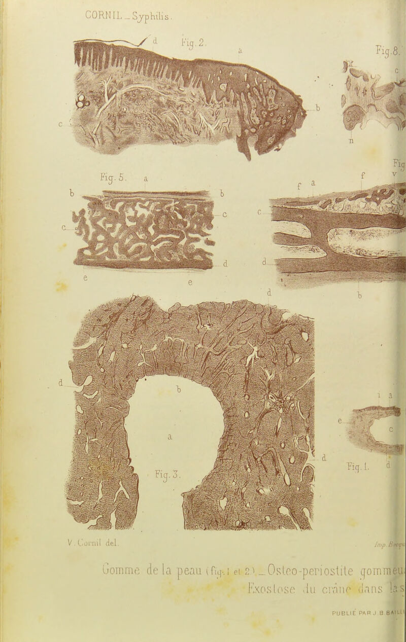 CORN 11. ..Syphilis F'i.ieUE HM1 .1 B BAItt