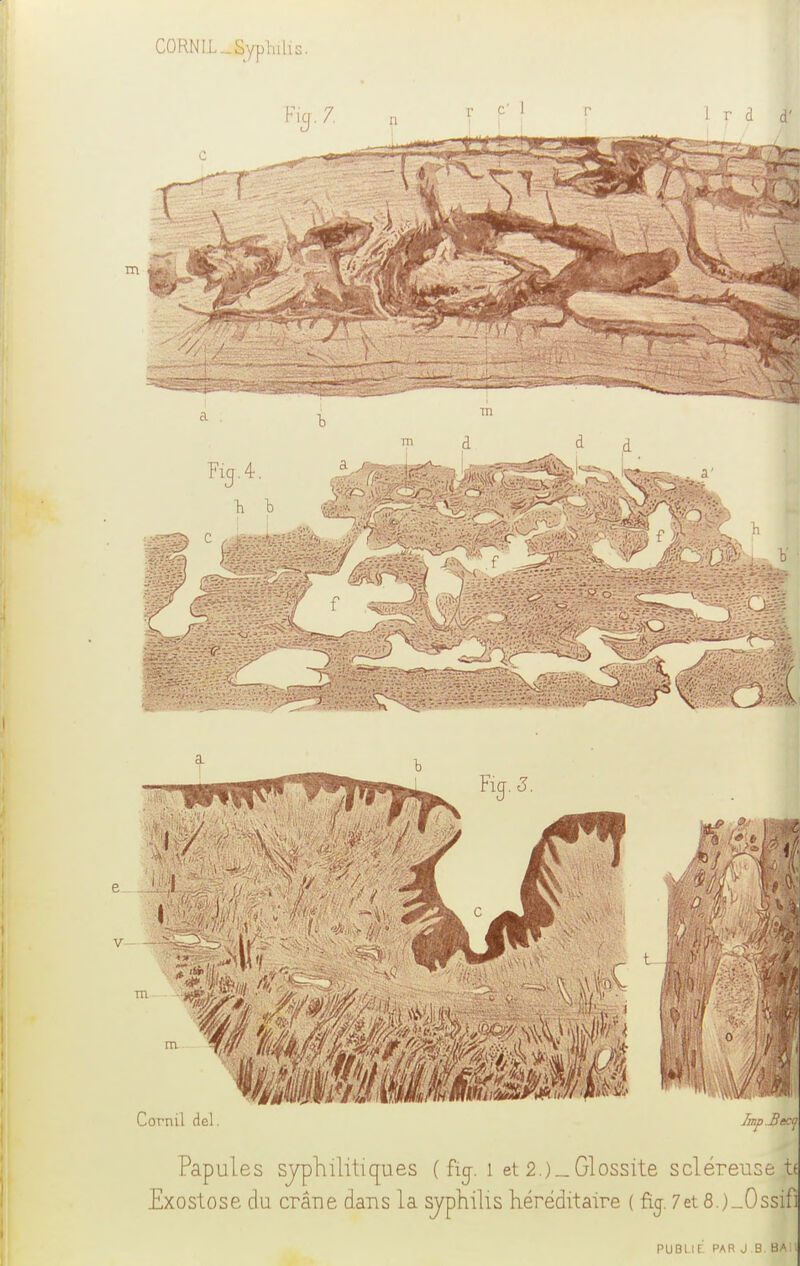 CORN IL _ Syphilis. Fid.4. h b Cornil del. Imp.Bec^ Papules syphilitiques ( fïg-. 1 et 2.)_Glossite scléreusejj Exostose du crâne dans la syphilis héréditaire ( fij. 7et8.)_0ssif] publie' par j.b. bA