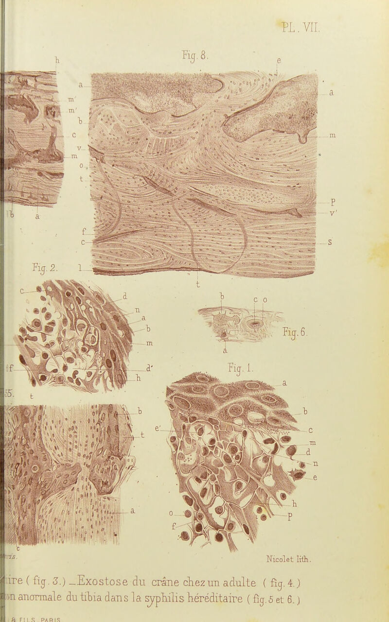 Nicolet lift. lire ( ficj. 3.) _Exostose du crâne chez un adulte ( fin. 4. ) m anormale du tibia dans la syphilis héréditaire ( %. 5 et 6. ) & FILS . PARIS