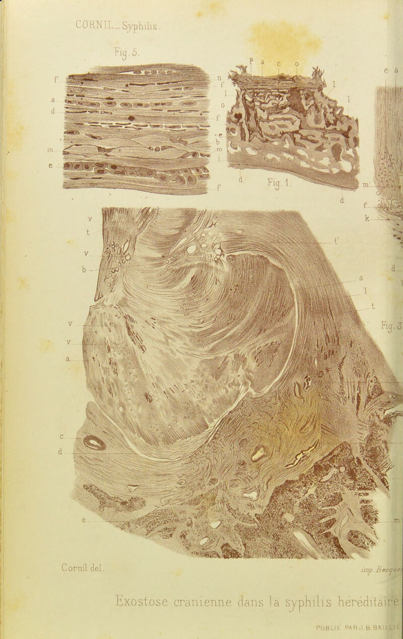 CORNIL-,SypMis tixostose crânienne dans la syphilis héréditai^H IMIH1.II PAH.I B BAIJH