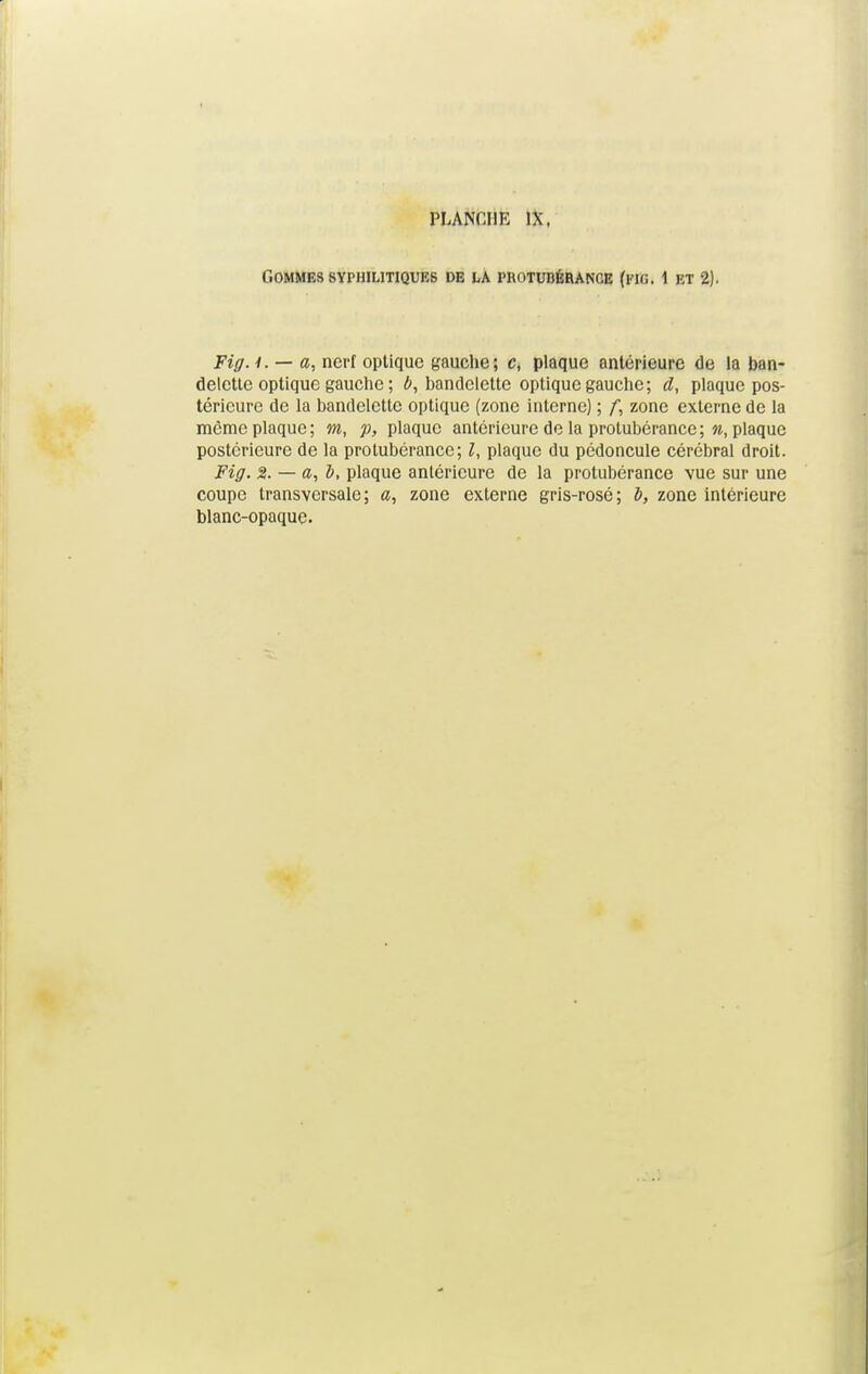 Gommes syphilitiques de la protubérance (kkj. 1 et 2). Fig. 4. — a, nerf optique gauche; c, plaque antérieure de la ban- delette optique gauche ; ô, bandelette optique gauche; d, plaque pos- térieure de la bandelette optique (zone interne) ; f, zone externe de la même plaque ; m, p, plaque antérieure de la protubérance; », plaque postérieure de la protubérance; l, plaque du pédoncule cérébral droit. Fig. %. — a, h, plaque antérieure de la protubérance vue sur une coupe transversale; a, zone externe gris-rosé; t, zone intérieure blanc-opaque.
