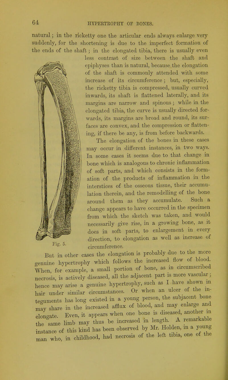 natural; in the ricketty one tlie articular ends always enlarge very suddenly, for the shortening is due to the imperfect formation of the ends of the shaft; in the elongated tibia, there is usually even less contrast of size between the shaft and epiphyses than is natural, because the elongation of the shaft is commonly attended with some increase of its circumference; but, especially, the ricketty tibia is compressed, usually curved inwards, its shaft is flattened laterally, and its margins are narrow and spinous; while in the elongated tibia, the curve is usually directed for- wards, its margins are broad and round, its sur- faces are convex, and the compression or flatten- ing, if there be any, is from before backwards. The elongation of the bones in these cases may occur in different instances, in two ways. In some cases it seems due to that change in bone which is analogous to chronic inflammation of soft parts, and which consists in the form- ation of the products of inflammation in the interstices of the osseous tissue, their accumu- lation therein, and the remodelling of the bone around them as they accumulate. Such a change appears to have occurred in the specimen from which the sketch was taken, and would necessarily give rise, in a growing bone, as it does in soft parts, to enlargement in every direction, to elongation as well as increase of circumference. But in other cases the elongation is probably due to the more genuine hypertrophy which foUows the increased flow of blood When, for example, a small portion of bone, as in circumscnbed necrosis, is actively diseased, all the adjacent part is more vascular; hence may arise a genuine hypertrophy, such as I have sho.vn m hair under simUar circumstances. Or when an ulcer of the m- teguments has long existed in a young person, the subjacent bone may share in the increased afflux of blood, and may enlarge and elongate. Even, it appears when one bone is diseased, another in the same limb may thus be increased in length A remarkable instance of this kind has been observed by Mr Ho den, m a yoimg man who, in childhood, had necrosis of the left tibia, one of the