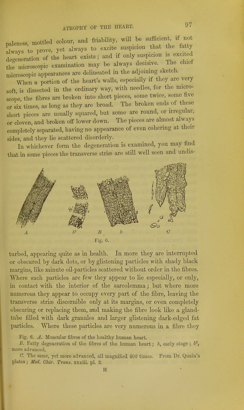 paleness, mottled colour, and fnabihty, wdl be !lways to prove, yet always to excite suspicion that the fatty de«tioi of the heart exists; and if only suspicion is excited the microscopic examination may he always decisive. The chiet microscopic appearances are delineated in the adjoining sketch. When a portion of the heart's walls, especially if they are very soft, is dissected in the ordinary way, with needles, for the micro- scope the fibres are broken into short pieces, some twice, some five or si^ times, as long as they are broad. The broken ends of these short pieces are usually squared, but some are round, or irregular, or cloven, and broken off lower down. The pieces are ahnost always completely separated, having no appearance of even cohering at their sides, and they lie scattered disorderly. In whichever form the degeneration is examined, you may find that in some pieces the transverse strise are still well seen and undis- turbed, appearing quite as in health. In more they are interrupted or obscured by dark dots, or by glistening particles with shady black margins, like minute oU-particles scattered vsdthout order in the fibres. Where such particles are few they appear to lie especially, or only, in contact with the interior of the sarcolemma; but where more numerous they appear to occupy every j^art of the fibre, leaving the transverse strise discernible only at its margins, or even completely obscuring or replacing them, and making the fibre look like a gland- tube filled with dark granules and larger glistening dark-edged fat particles. Where these particles are very numerous in a fibre they Fig. 6. A. Muscular fibres of the healthy human heart. £. Fatty degencratiou of the fibres of the human heart; b, early stage ; b, more advanced. 0. The same, yet more advanced, all magnified 400 times. From Dr. Quain's plates; Med. Ohio: Tram, xxxiii. pi. 3. H