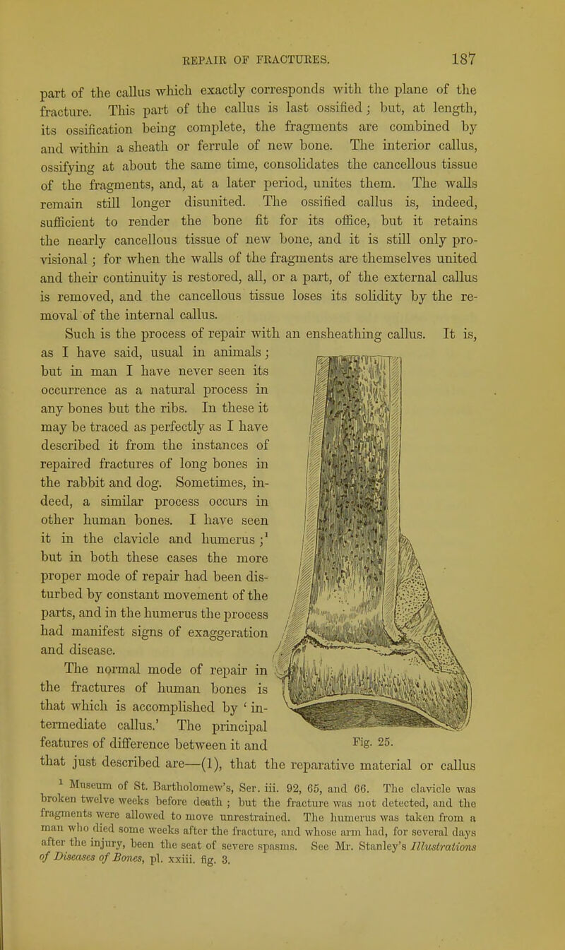 part of the calkis which exactly corresponds with the plane of the fracture. This part of the callus is last ossified; but, at length, its ossification being complete, the fragments are combined by and within a sheath or ferrule of new bone. The interior callus, ossifying at about the same time, consolidates the cancellous tissue of the fragments, and, at a later period, unites them. The walls remain still longer disunited. The ossified callus is, indeed, sufiicient to render the bone fit for its ofiice, but it retains the nearly cancellous tissue of new bone, and it is still only pro- visional ; for when the walls of the fragments are themselves united and their continuity is restored, all, or a part, of the external callus is removed, and the cancellous tissue loses its solidity by the re- moval of the internal callus. Such is the process of repair with an ensheathing callus. It is, as I have said, usual in animals; but in man I have never seen its occurrence as a natural process in any bones but the ribs. In these it may be traced as perfectly as I have described it from the instances of ref)aired fractures of long bones in the rabbit and dog. Sometimes, in- deed, a similar process occurs in other human bones. I have seen it in the clavicle and humerus but in both these cases the more proper mode of repair had been dis- turbed by constant movement of the parts, and in the humerus the process had manifest signs of exaggeration and disease. The noi-mal mode of rej)air in the fractures of human bones is that which is accomplished by ' in- termediate callus.' The principal features of difference between it and ^'S- that just described are—(1), that the reparative material or callus ^ Museum of St. Bartholomew's, Ser. iii. 92, 65, and 66. Tlie clavicle was broken twelve weeks before death ; but the fractiu-e was not detected, and the fragments were allowed to move unrestrained. The humerus was taken from a man wlio died some weeks after the fracture, and whose ai-m had, for several days after the injury, been the seat of severe spasms. See Mr. Stanley's Illustrations of Diseases of Bones, pi. xxiii. fig. 3,