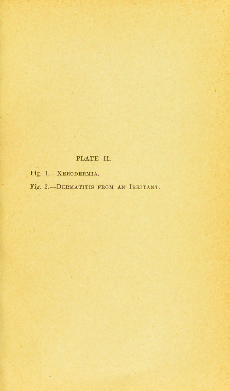 PLATE II. Fig. 1.—Xekodebmia. Fig. 2.—Dermatitis from an Irritant.