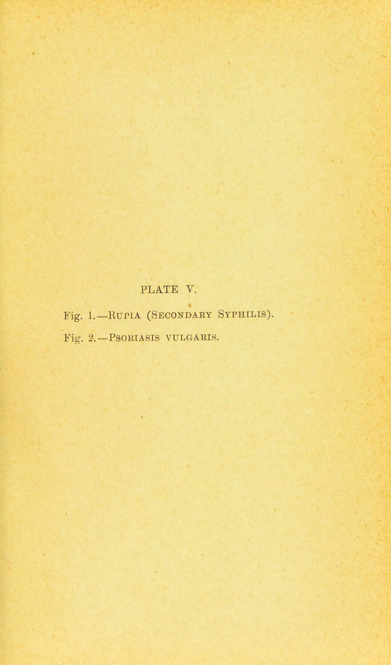 PLATE V. Fig. 1.— Rupia (Secondary Syphilis). Fig. 2.—Psoriasis vulgaris.