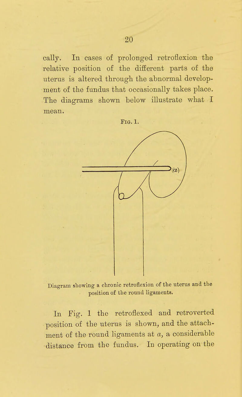 cally. In cases of prolonged retroflexion tlie relative position of the different parts of the uterus is altered througli the abnormal develop- ment of the fundus that occasionally takes place. The diagrams shown below illustrate what I mean. Fig. 1. Diagram showing a chronic retroflexion of the uterus and the position of the round ligaments. In Fig. 1 the retroflexed and retroverted position of the uterus is shown, and the attach- ment of the round ligaments at a, a considerable distance from the fundus. In operating on the
