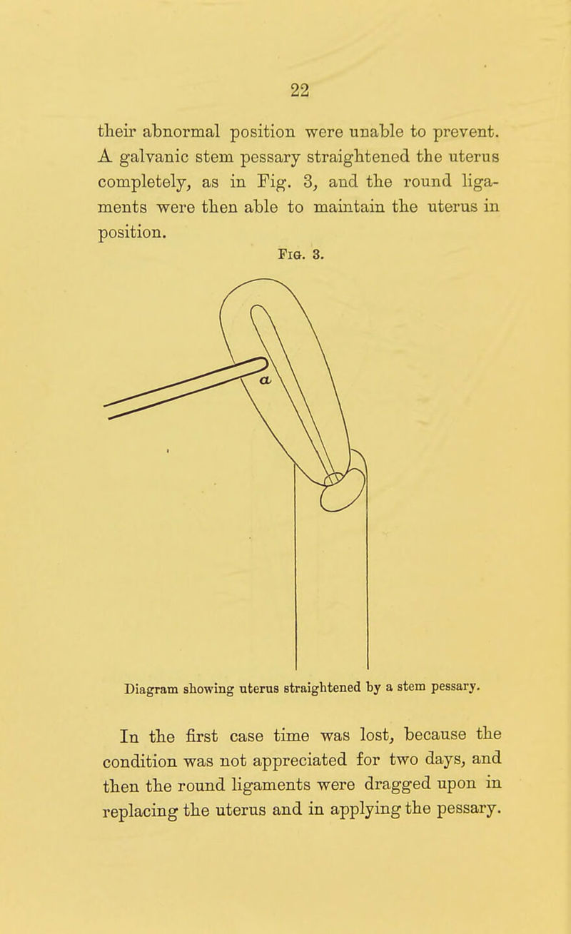 tlieir abnormal position were unable to prevent. A galvanic stem pessary straightened the uterus completely, as in Pig. 3, and the round liga- ments were then able to maintain the uterus in position. Fig. 3, Diagram showing uterus straightened by a stem pessary. In the first case time was lost, because the condition was not appreciated for two days, and then the round ligaments were dragged upon in replacing the uterus and in applying the pessary.