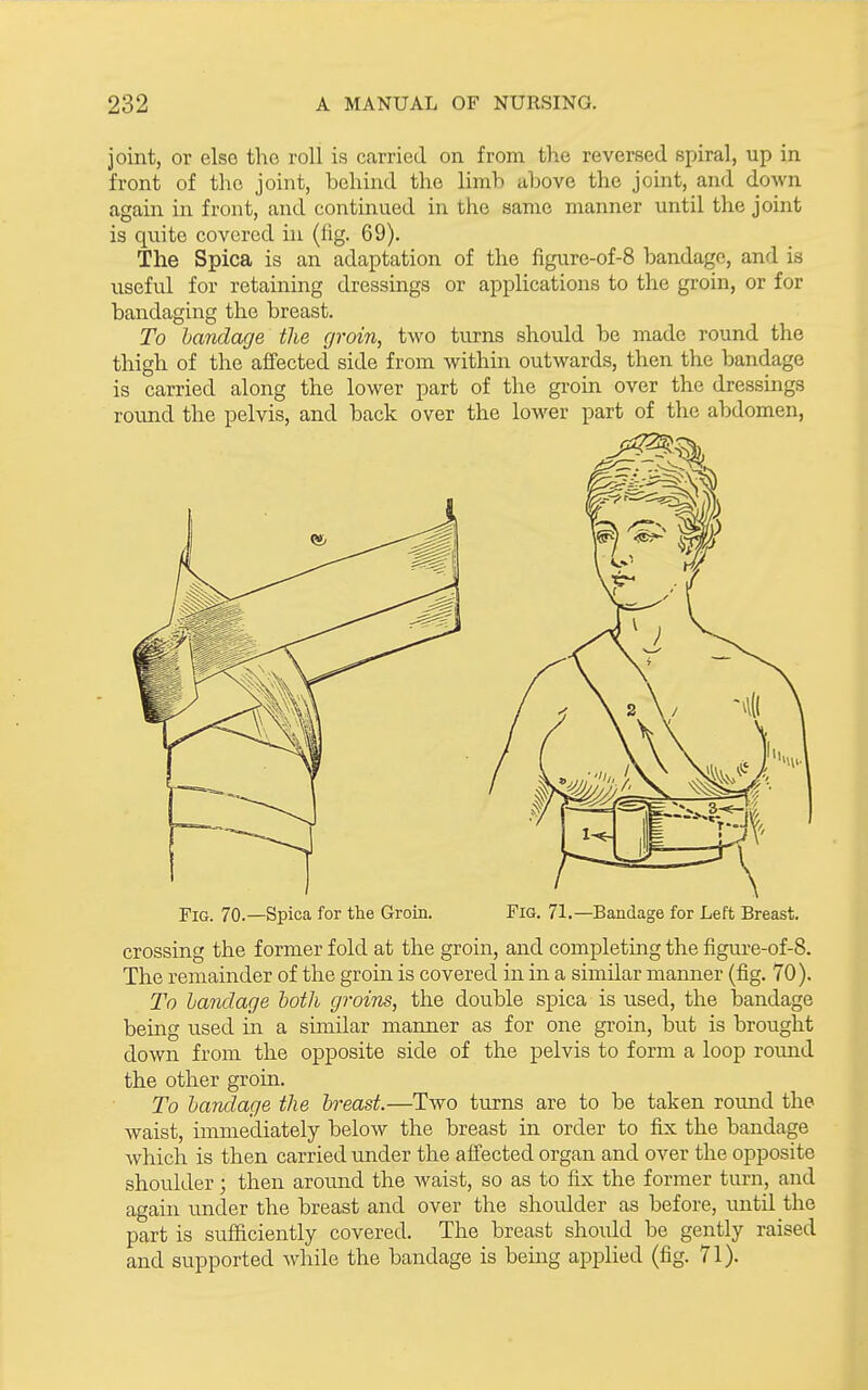 joint, or else the roll is carried on from the reversed spiral, up in front of the joint, behind the limh above the joint, and down again in front, and continued in the same manner until the joint is qxiite covered in (lig. 69). The Spica is an adaptation of the figure-of-8 bandage, and is useful for retaining dressings or applications to the groin, or for bandaging the breast. To bandage the groin, two turns should be made round the thigh of the affected side from within outwards, then the bandage is carried along the lower part of the groin over the dressings round the pelvis, and back over the lower part of the abdomen, Fig. 70.—Spica for the Groin. Fig. 71.—Bandage for Left Breast. crossing the former fold at the groin, and completing the figure-of-8. The remainder of the groin is covered in in a similar manner (fig. 70). To bandage both groins, the double spica is used, the bandage being used in a similar manner as for one groin, but is brought down from the opposite side of the pelvis to form a loop round the other groin. To bandage the breast.—Two turns are to be taken round the waist, immediately below the breast in order to fix the bandage which is then carried under the affected organ and over the opposite shoidder; then around the Avaist, so as to fix the former turn, and again under the breast and over the shoulder as before, until the part is sufficiently covered. The breast should be gently raised and supported while the bandage is being applied (fig. 71).