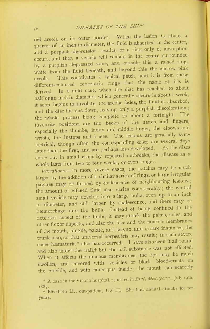 red areola on its outer border. When the lesion is about a quarter of an inch in diameter, the fluid is absorbed in the centre, and a purplish depression results, or a ring only of absorption occurs, and then a vesicle will remain in the centre surrounded by a purplish depressed zone, and outside this a raised ring white from the fluid beneath, and beyond this the narrow pink areola This constitutes a typical patch, and it is from these different-coloured concentric rings that the name of ins is derived In a mild case, when the disc has reached to about half or an inch in diameter, which generally occurs in about a week, it soon begins to involute, the areola fades, the fluid is absorbed, and the disc flattens down, leaving only a purplish discoloration ; the whole process being complete in about a fortnight. The favourite positions are the backs of the hands and fingers especially the thumbs, index and middle finger, the elbows and wrists, the insteps and knees. The lesions are generally sym- metrical, though often the corresponding discs are several days later than the first, and are perhaps less developed. As the discs come out in small crops by repeated outbreaks, the disease as a whole lasts from two to four weeks, or even longer. Variations.-^ more severe cases, the patches may be much larger by the addition of a similar series of rings, or large irregular patches may be formed by coalescence of neighbouring lesions ; the amount of effused fluid also varies considerably; the central small vesicle may develop into a large bulla, even up to an inch in diameter, and still larger by coalescence, and there may he hemorrhage into the bulla. Instead of being confined to the extensor aspect of the limbs, it may attack the palms, soles, and other flexor aspects, and also the face and the mucous membranes of the mouth, tongue, palate, and larynx, and in rare instances, the trunk also, so that universal herpes iris may result; in such severe cases hematuria * also has occurred. I have also seen it all round and also under the nail,t but the nail substance was not affected. When it affects the mucous membranes, the lips may be much swollen, and covered with vesicles or black blood-crusts on the outside, and with muco-pus inside; the mouth can scarcely • A case in the Vienna hospital, reported in Brit. Med. four., July 19th. '^Elizabeth M., out-patient, U.C.H. She had annual attacks for ten years.