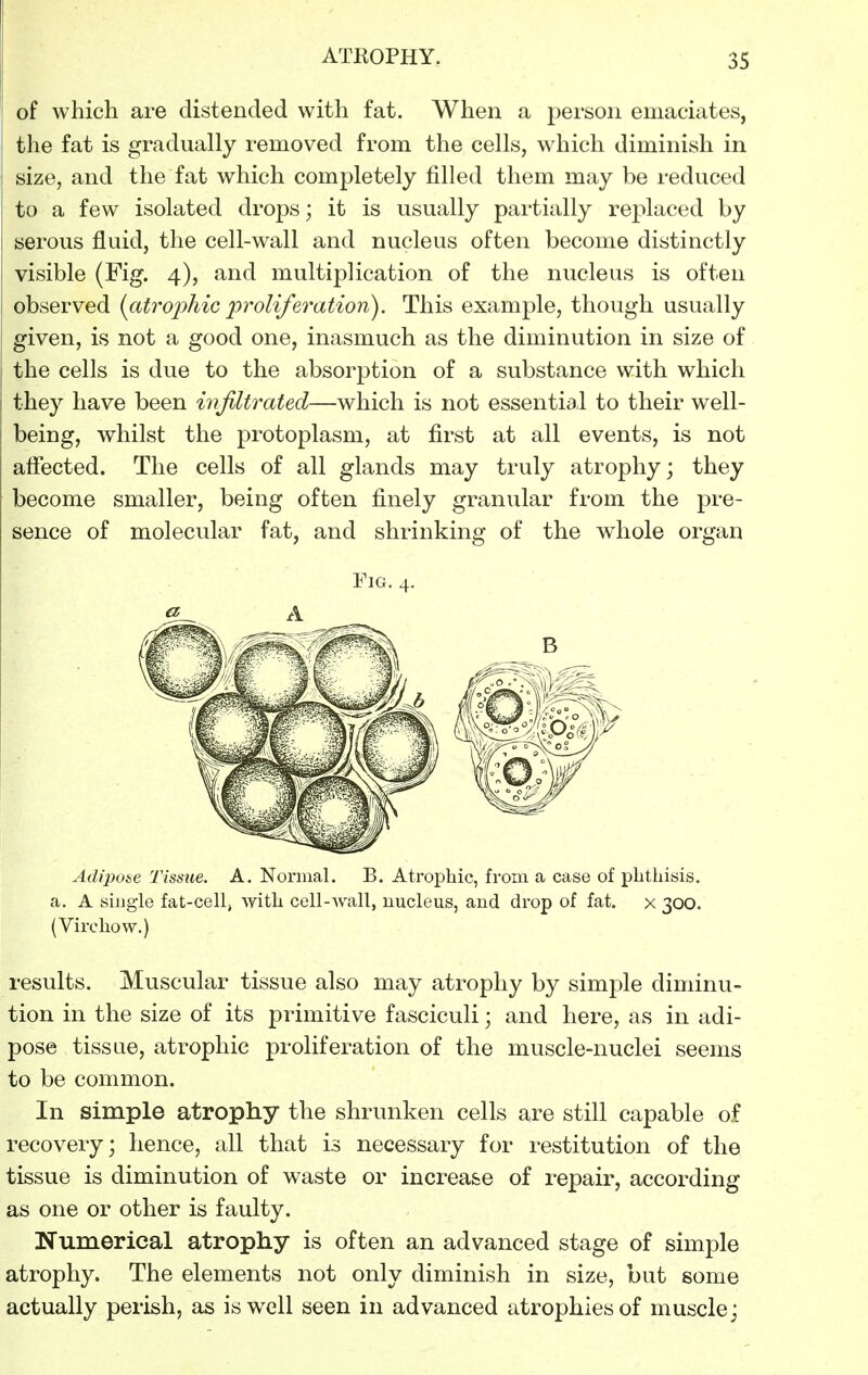 of which are distended with fat. When a person emaciates, the fat is gradually removed from the cells, which diminish in size, and the fat which completely filled them may be reduced to a few isolated drops; it is usually partially replaced by serous fluid, the cell-wall and nucleus often become distinctly visible (Fig. 4), and multiplication of the nucleus is often observed {atrojyhic 'proliferation). This example, though usually given, is not a good one, inasmuch as the diminution in size of the cells is due to the absorption of a substance with which they have been infiltrated—which is not essential to their well- being, whilst the protoplasm, at first at all events, is not affected. The cells of all glands may truly atrophy; they become smaller, being often finely granular from the pre- sence of molecular fat, and shrinking of the whole organ Fig. 4. A Adipoae Tissue. A. Nonual. B. Atrophic, from a case of plithisis. a. A single fat-cell^ with cell-wall, nucleus, and drop of fat. x 300. (Virchow.) results. Muscular tissue also may atrophy by simple diminu- tion in the size of its primitive fasciculi; and here, as in adi- pose tissue, atrophic proliferation of the muscle-nuclei seems to be common. In simple atrophy the shrunken cells are still capable of recovery; hence, all that is necessary for restitution of the tissue is diminution of waste or increase of repair, according as one or other is faulty. Numerical atrophy is often an advanced stage of simple atrophy. The elements not only diminish in size, but some actually perish, as is well seen in advanced atrophies of muscle;