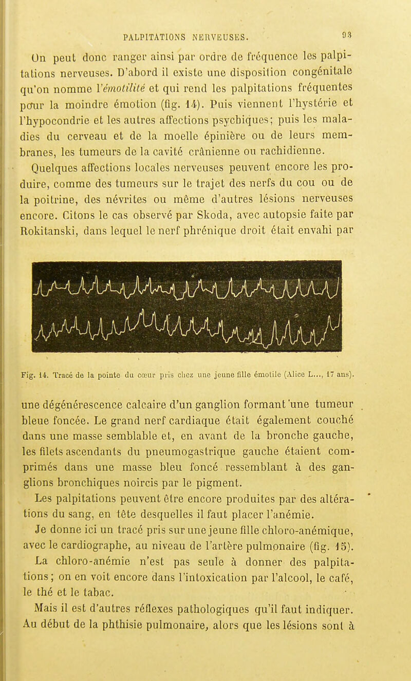 PALPITATIONS NERVEUSES. On peut donc rangci- ainsi par ordre de fréquence les palpi- tations nerveuses. D'abord il existe une disposition congénitale qu'on nomme Vémotililé et qui rend les palpitations fréquentes pcfur la moindre émotion (fig. 14.). Puis viennent l'hystérie et l'hypocondrie et les autres affections psychiques; puis les mala- dies du cerveau et de la moelle épinière ou de leurs mem- branes, les tumeurs de la cavité crânienne ou rachidienne. Quelques affections locales nerveuses peuvent encore les pro- duire, comme des tumeurs sur le trajet des nerfs du cou ou de la poitrine, des névrites ou même d'autres lésions nerveuses encore. Citons le cas observé par Skoda, avec autopsie faite par Rokitanski, dans lequel le nerf phrénique droit était envahi par Fig. 14. Tracé de la pointe du cœur pi-is olicz une jeune fille émolile (Alice L..., 17 ans). une dégénérescence calcaire d'un ganglion formant'une tumeur bleue foncée. Le grand nerf cardiaque était également couché dans une masse semblable et, en avant de la bronche gauche, les filets ascendants du pneumogastrique gauche étaient com- primés dans une masse bleu foncé ressemblant à des gan- glions bronchiques noircis par le pigment. Les palpitations peuvent être encore produites par des altéra- tions du sang, en tête desquelles il faut placer l'anémie. Je donne ici un tracé pris sur une jeune fille chloro-anémique, avec le cardiographe, au niveau de l'artère pulmonaire (fig. J5). La chloro-anémie n'est pas seule à donner des palpita- tions; on en voit encore dans l'intoxication par l'alcool, le café, le thé et le tabac. Mais il est d'autres réflexes pathologiques qu'il faut indiquer. Au début de la phthisie pulmonaire, alors que les lésions sont à