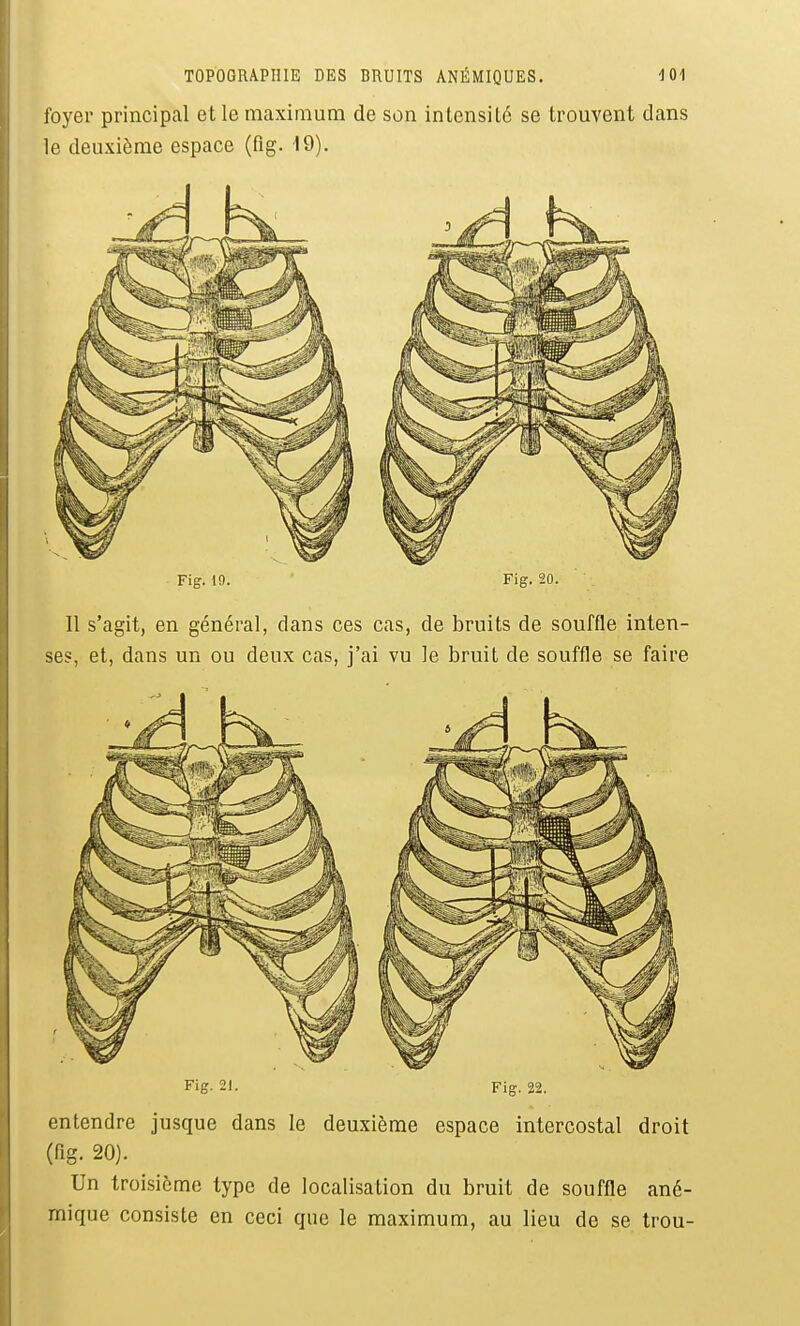 foyer principal et le maximum de son intensité se trouvent dans le deuxième espace (fig. 19). Fig. 19. • Fig. 20. Il s'agit, en général, dans ces cas, de bruits de souffle inten- ses, et, dans un ou deux cas, j'ai vu le bruit de souffle se faire Fig, 21. Fig. 22. entendre jusque dans le deuxième espace intercostal droit (flg. 20). Un troisième type de localisation du bruit de souffle ané- mique consiste en ceci que le maximum, au lieu de se trou-