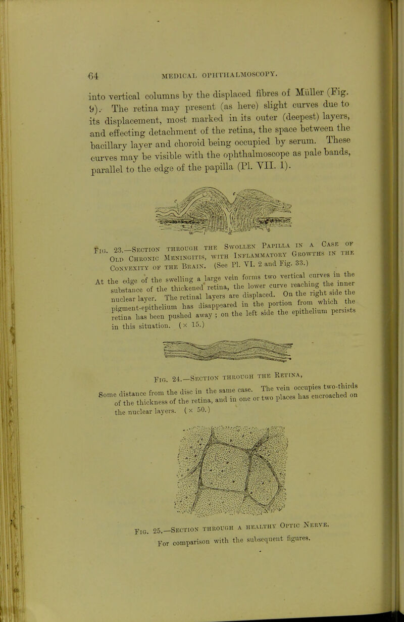 into vertical columns by the displaced fibres of Miiller (Fig. 9).- The retina may present (as here) slight curves due to its displacement, most marked in its outer (deepest) layers, and effecting detachment of the retina, the space between the bacillary layer and choroid being occupied by serum. These curves may be visible with the ophthalmoscope as pale bands, parallel to the edge of the papilla {VI. YII. 1). Vrr 23-Section through the Swollex Papilla in a Case of '•OLX; cZTc MENINOITIS, WITH InELAMMATOKV GhOWTHS IN THK Convexity of the Brain. (See PL VI. 2 and Fig. 33.) At the edce of the swelling a large vein forms two vertical curves in the tbst^^e of the tluclcrned-retina, the lower ----^^.f-- nuclear layer. The retinal layers are displaced. On the iight side tlie Xmentiep thelium has disappeared in the portion from which the has'been pushed away ; on the left side the epithehum persists in this situation, (x 15.) Pig 24 —Section through the Retina, the nuclear layers. ( x 50.) r,G. 25.-SECTIOX THROUGH A HEALTHV Ol'TIC NeRVE. For comparison with the subsequent figures.