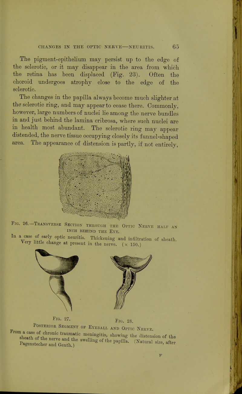 The pigment-epithelium may persist up to the edge of the sclerotic, or it may disappear in the area from which the retina has been displaced (Fig. 23). Often the choroid undergoes atrophy close to the edge of the sclerotic. The changes in the papilla always become much slighter at the sclerotic ring, and may appear to cease there. Commonly, however, large numbers of nuclei lie among the nerve bundles in and just behind the lamina cribrosa, where such nuclei are in health most abundant. The sclerotic ring may appear distended, the nerve tissue occupying closely its funnel-shaped area. The appearance of distension is partly, if not entirely. Fig. 26.-Transverse Section through the Optic Nerve half an INCH BEHIND THE EyE. In a case of early optic neuritis. Thickening and iuiiltration of sheath. Very little change at present in the nerve, (x 150.) Fig. 27. Fig, 28. Posterior Segment of Eyeball and Optic Nerve sheXoftS'r '^-t--- of the