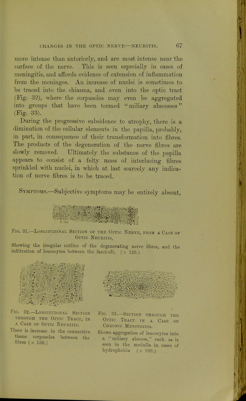 more intense than anteriorly, and are most intense near tlie surface of the nerve. This is seen especially in cases of meningitis, and affords evidence of extension of inflammation from the meninges. An increase of nuclei is sometimes to be traced into the chiasma, and even into the optic tract (Fig. 32), where the corpuscles may even be aggregated into groups that have been termed miliary abscesses (Fig. 33). During the progressive subsidence to atrophy, there is a diminution of the cellular elements in the papilla, probably, in part, in consequence of their transformation into fibres. The products of the degeneration of the nerve fibres are slowly removed. Ultimately the substance of the papilla appears to consist of a felty mass of interlacing fibres sprinkled with nuclei, in which at last scarcely any indica- tion of nerve fibres is to be traced. Symptoms.—Subjective symptoms may be entirely absent, Fig. 31.—Longitudinal Section of the Optic Nerve, from a Case of Optic Neuritis, Showing tlie irregular outline of the degenerating nerve fibres, and the infiltration of leucocytes between the fasciculi. ( x 120.) Fig. 32.—Longitudinal Section through the Optic Tract, in A Case of Optic Neuritis. There is increase in the connective tissue corpuscles between the fibres ( X 150.) - -w8- - OF Fig. 33.—Section through tuk Optic Tract in a Case Chronic Meningitis. Shows aggregation of leucocytes into a miliary abscess, such as is seen in the medulla in cases of hydrophobia ( x 100.)