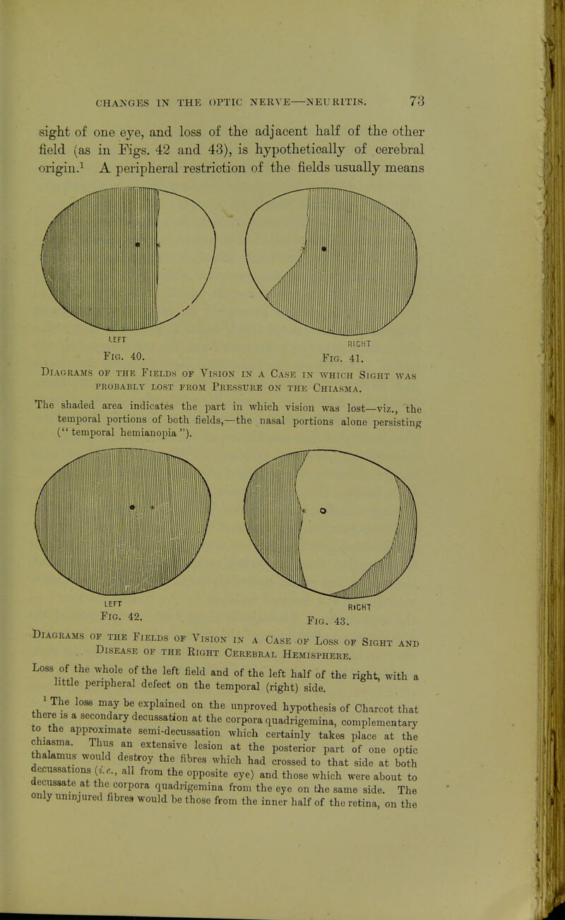 sight of one eye, and loss of the adjacent half of the other field (as in Figs. 42 and 43), is hypothetioally of cerebral origin.^ A peripheral restriction of the fields usually means ^^^^ _ RIGHT Fig. 40. Fig. 41. Diagrams of the Field.s of Vision in a Case in avhich Sight was PROBABLY LOST FROM PRESSURE ON THE ChIASMA. The shaded area indicates the part in which vision was lost—viz., the temporal portions of both fields,—the nasal portions alone persisting (temporal hemianopia ). Fig. Diagrams of the Fields of Vision in a Case of Loss of Sight and Disease of the Right Cerebral Hemisphere. Loss of the whole of the left field and of the left half of the right, with a little peripheral defect on the temporal (right) side. ' The lose may be explained on the unproved hypothesis of Charcot that there IS a secondary decussation at the corpora quadrigemina, complementary to the approximate semi-decussation which certainly takes place at the chiasma. Thus an extensive lesion at the posterior part of one optic thalamus would destroy the fibres which had crossed to that side at both decussations (z..., all from the opposite eye) and those which were about to aecussate at the corpora quadrigemina from the eye on the same side. The only uninjured fibres would be those from the inner half of the retina on the