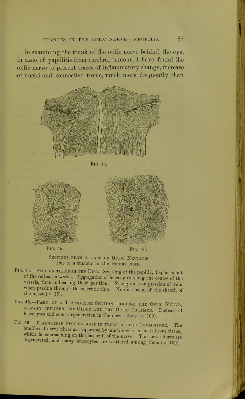 In examining the trunk of the optic nerve behind the eye, in cases of papillitis from cerebral tumour, I have found the optic nerve to present traces of inflammatory change, increase of nuclei and connective tissue, much more frequently than ili Fro. 44. ^^^^^^^'I5 ;^^^'^f ''^^ Fig. 45. Fig. 46. Sections from a Case of Optic Neuhitis Due to a tumour in the frontal lobes. Fig. 44.—Section through the Disc. Swelling of the papilla, displacement of the retina outwards. Aggregation of leucocytes along the course of the vessels, thus indicating their position. No sign of compression of vein when passing through the sclerotic ring. No distension of the sheath of the nerve ( x 15). Fig. 45.—Part of a Transverse Section through the Optic Nerve, midway between the Globe and the Optic Foramen. Increase of leucocytes and some degeneration in the nerve fibres ( x 100). Fig. 46.—Transverse Section just in front of the Commissure. The bundles of nerve fibres are separated by much newly formed fibrous tissue, which is encroaching on the fasciculi of the nerve. The nerve fibres are degenerated, and many leucocytes are scattered among them ( x 100).